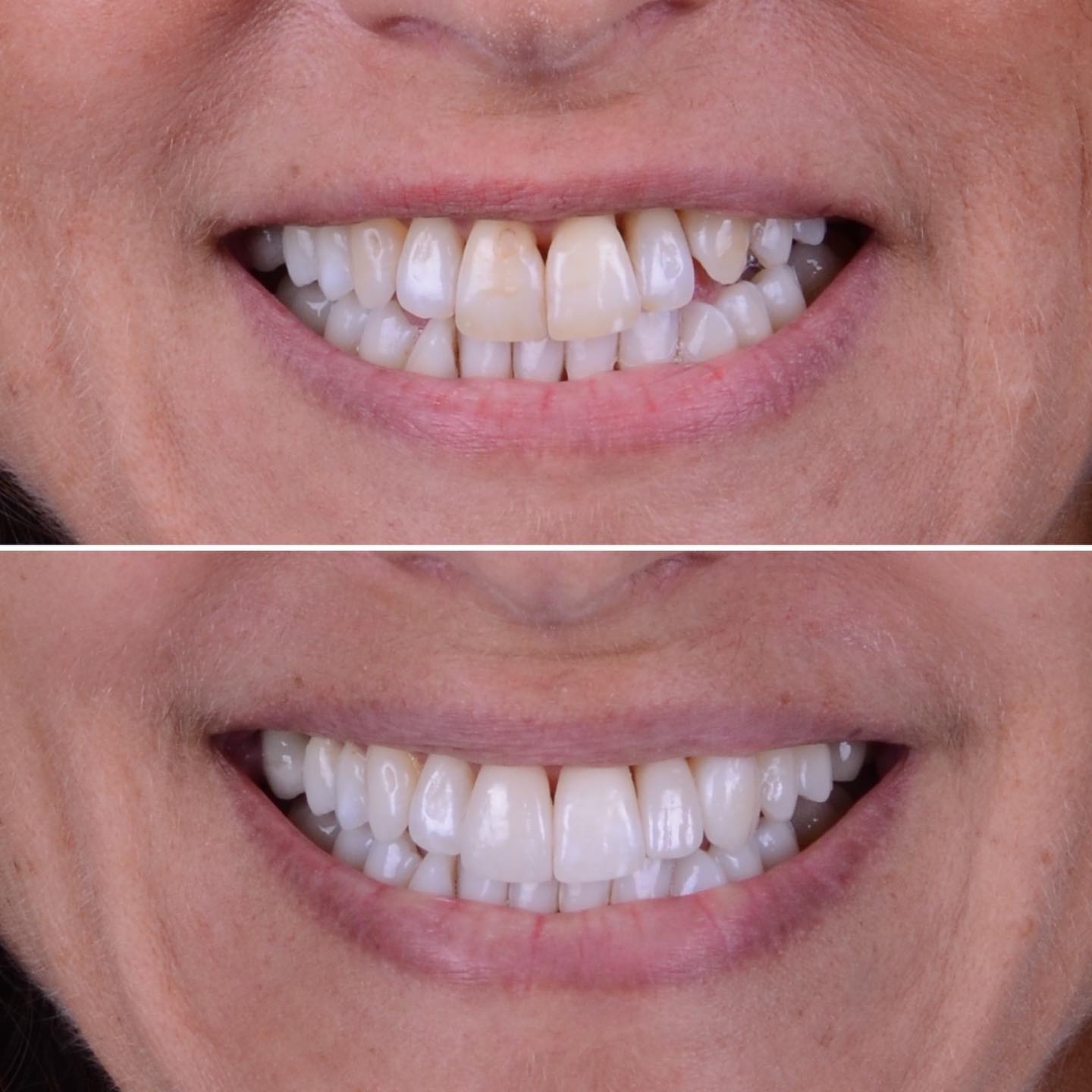 This is a very special before and after. The patient wanted a super conservative approach to make sure her teeth still look the same - but improved.
For this smile makeover super thin non-prep (layered on platinum foil) veneers were added to only 3 teeth. On two other teeth black triangles were closed with a special composite technique.
And to improve the color the patient used a combination of office and home bleaching.
Amazing to see how subtle changes have a huge impact on the overall appearance of the smile.
#abudhabidentist #dentistabudhabi #dubaidentist #dentistdubai #smiledesign #digitalsmiledesign #zahnarzt #dentist #estheticdentistry #veneers #3shape #highenddentistry #digitaldentistry #predictibledentistry #adent #veneersabudhabi #abudhabiveneers #veneersdubai #fullmouthrehabilitation #biomimeticdentistry #functionaldentistry