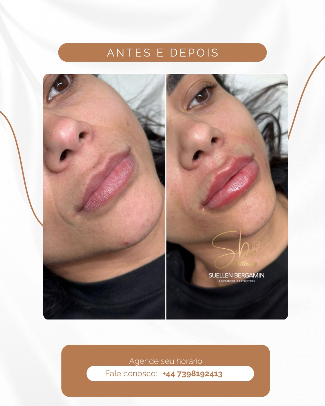 💭 “Eu quero… mas tenho medo de ficar artificial.”
💭 “E se não combinar comigo?”
Se você já pensou isso, esse post é pra você.
O preenchimento labial não é sobre exagero.
É sobre harmonia e proporção.
É para quem quer:
✨ Realçar o contorno
✨ Corrigir pequenas assimetrias
✨ Dar aquele volume sutil que faz diferença
E tudo começa com uma avaliação personalizada, onde cada detalhe é pensado para valorizar a sua beleza, sem mudar quem você é.
Vem conversar comigo, vou adorar fazer isso por você. 😉🧡
+44 7398 192413
.
💭 “I want it… but I’m afraid it will look artificial.”
💭 “What if it doesn’t suit me?”
If you’ve ever thought this, this post is for you.
Lip filler is not about exaggeration.
It’s about harmony and proportion.
It’s for those who want to:
✨ Enhance the lip contour
✨ Correct small asymmetries
✨ Add that subtle volume that makes all the difference
And it all starts with a personalized assessment, where every detail is carefully considered to enhance your beauty — without changing who you are.
Come talk to me, I’d love to do this for you. 😉🧡
+44 7398 192413