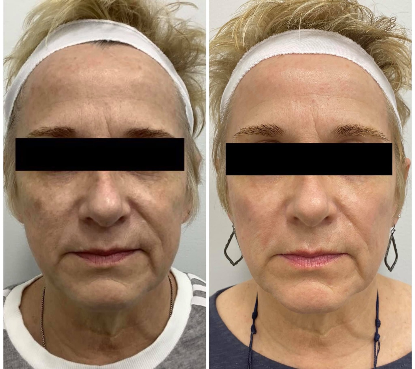 This is after just ONE TCA chemical peel 🙌
• Smooths fine lines & wrinkles
• Fades sunspots & pigmentation
• Improves the appearance of acne scarring
Call or book online to schedule your consult to see if you’re a good candidate.