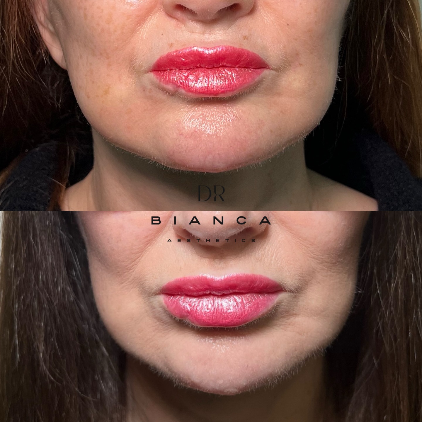 ✨ Why we do Chin (Mentalis) Toxin ✨
The mentalis muscle plays a huge role in the shape and expression of the lower face. As we age, this muscle becomes overactive and shortens, pulling the chin upwards and inwards. The result?
• Chin dimpling / “orange peel” texture
• A shortened lower face
• Loss of that soft, youthful heart-shaped contour
In this patient, following her deep plane neck and facelift, we used a small, precise dose of neuromodulator toxin to the mentalis as the finishing touch. By gently relaxing the muscle, we were able to:
✔️ Reduce chin dimpling
✔️ Allow the chin to sit lower and smoother
✔️ Restore balance to the lower third of the face
✔️ Enhance a youthful, heart-shaped facial proportion
It’s a subtle treatment, but one that makes a powerful difference when it comes to refinement and harmony. 💫
📍 Based in Washington
📅 Bookings: www.doctorbianca.co.uk
📲 Follow us: @drbianca_aesthetics