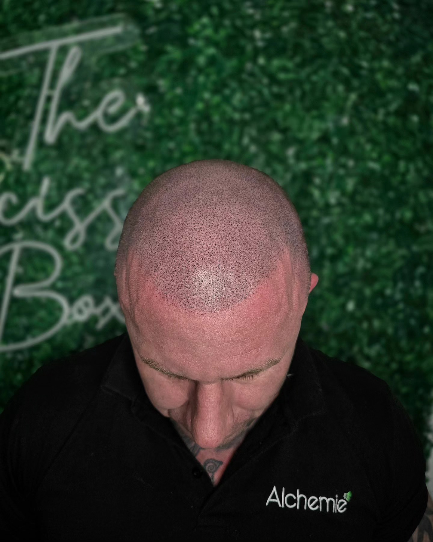 THIS IS NOT REAL HAIR!!
SCALP MICRO-PIGMENTATION FOR HAIR LOSS CREATES THE REALISTIC IMPRESSION OF A SHAVED HEAD!
The only hair loss solution that works every time, because there is no actual hair involved! 💯
Cosmetic tattooing for hair loss with natural looking results!
Enquire today to see how a hair tattoo can help you solve hair loss
📍Bury St Eds & Brighton Studios
#scalppigmentation #smpu #pmu #hairloss #hairtattoo