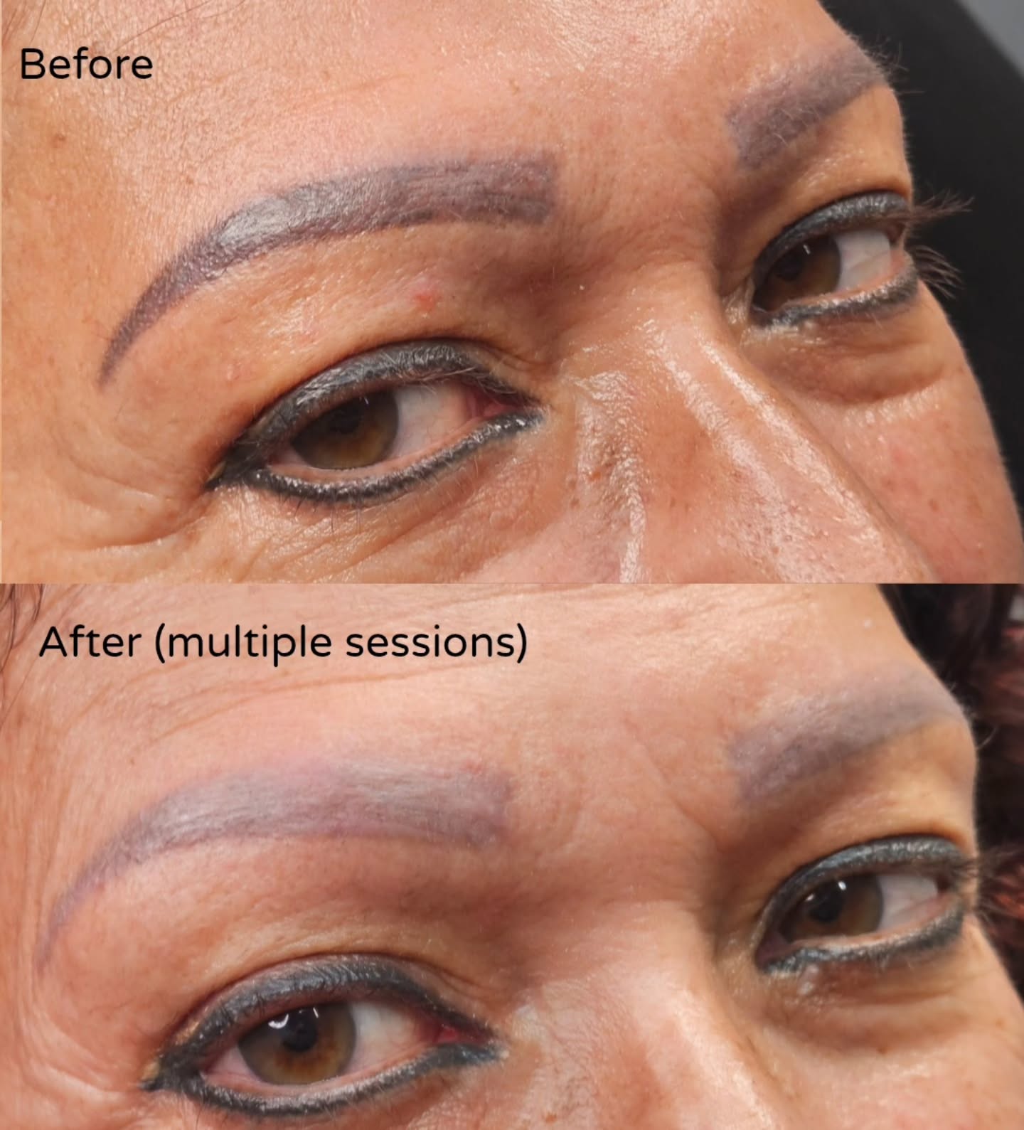 Before โ After
Saline tattoo removal after multiple sessions.
Removal is a process โ slow, controlled, and designed to protect the skin while lifting unwanted pigment over time.
If youโve been living with brows you regret and didnโt even know removal was an option, youโre not alone.
๐ค Free virtual consultations available
Original tattoo not performed by me.