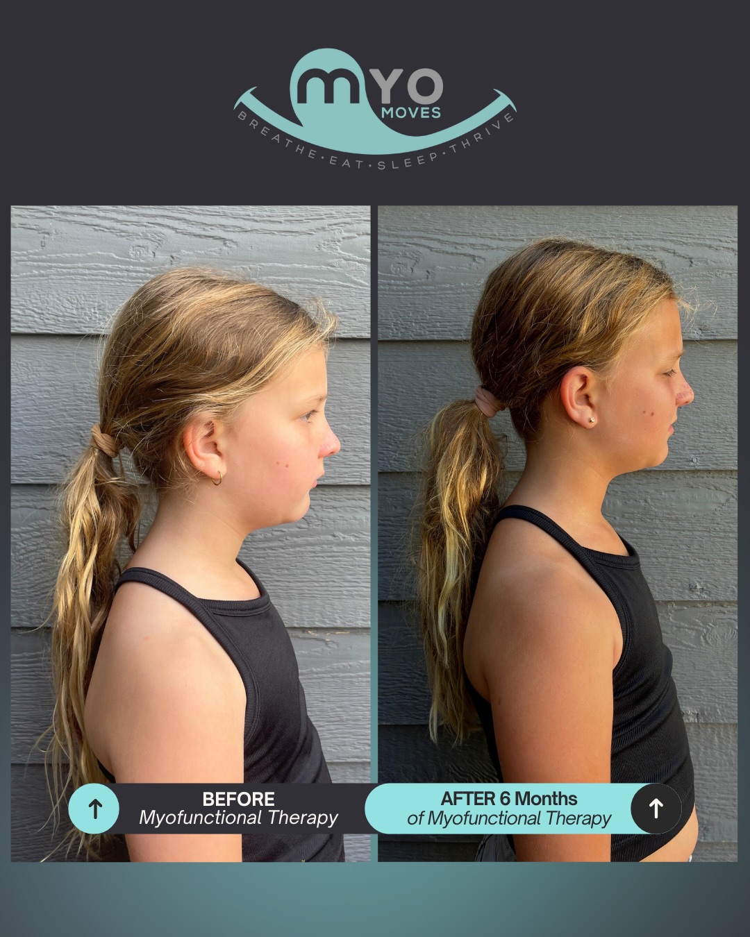 At first glance, these changes may look subtle, but when you know what to look for, the impact is huge!
In the before photos, her body has to help the tongue:
→ head comes forward
→ shoulders round
→ symmetry is lost
In the after photos?
✔️ Tongue stays centered and controlled
✔️ Head no longer jutting forward to “help” the tongue
✔️ Shoulders relax back into alignment
✔️ Improved symmetry and overall posture
When the tongue doesn’t have the strength or coordination it needs, the body borrows help from the neck, shoulders, and posture. Myofunctional therapy teaches the tongue to do its job, allowing the body to work without compensation.
This only happens with consistent, guided therapy and a whole-body approach! Comment “GUIDANCE” if you want to learn how myofunctional therapy could support your child (or yourself) and what the next step could look like!
#airwayhealth