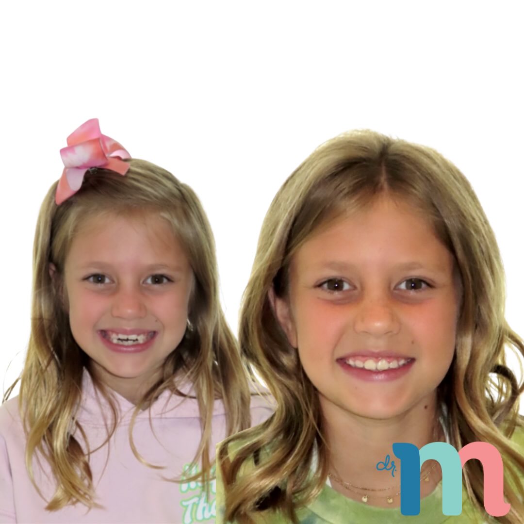 Transformation Tuesday ✨
Open bites are one of the hardest malocclusions to correct, which is why early treatment matters. Catching it early helps break tongue-thrust habits and leads to more stable results. And can we talk about this cutie’s smile?! 💕
•
•
📍 Huntington Beach | Orange County | California
☎️ (714) 500-7147
🌎 www.messenger-smiles.com
•
•
•
#TransformationTuesday #OpenBite #EarlyOrthodontics #SmileTransformation #CuteSmile