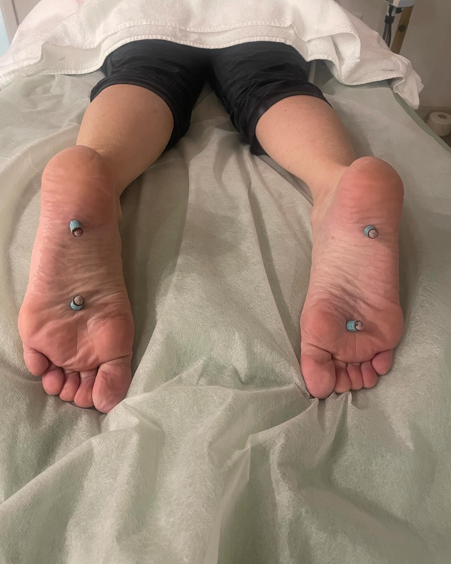 Foot pain or plantar fasciitis that just won’t soften up or heal? 🔥
In Chinese medicine, chronic heel and arch pain is often linked to Kidney channel deficiency and cold.
✨ Moxibustion gently warms the Kidney meridian, increases circulation, reduces inflammation, and supports deep tissue repair—especially for stubborn plantar fasciitis.
At Moment Wellness Acupuncture in Conifer, Colorado, we use acupuncture + moxa to treat foot pain at the root, not just the symptoms.
👣 Warm the channel. Nourish the Kidney. Heal the foot.
#PlantarFasciitisRelief #FootPainRelief #Moxibustion #ChineseMedicine #AcupunctureConifer #MomentWellnessAcupuncture #KidneyChannel #HolisticPainRelief #NaturalHealing