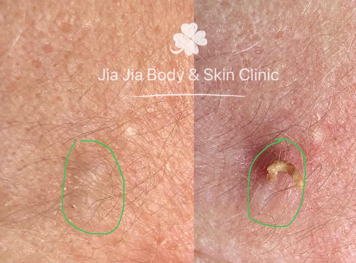 ComedoneĀ occurs when sebaceous gland is clotted with excess of sebum production and result in a plug at the top of the pore.ā£ā£ā£ā£ā£ā£
ā£ā£ā£ā£ā£ā£
ā£ā£Call for an appointment to discuss customizing a treatment protocol which is the best for your skin type.⣠ā£ā£ā£ā£ā£ā£ā£ā£ā£
ā£ā£ā£ā£ā£ā£ā£ā£
Jia Jia Body & Skin Clinic
āļø 02 98083880 or SMS 0401697198
#blackhead #comedone #extractions #acnetreatment #laser #skincare #blemishes #acne #skintagremoval #drpimplepopper #clearskin