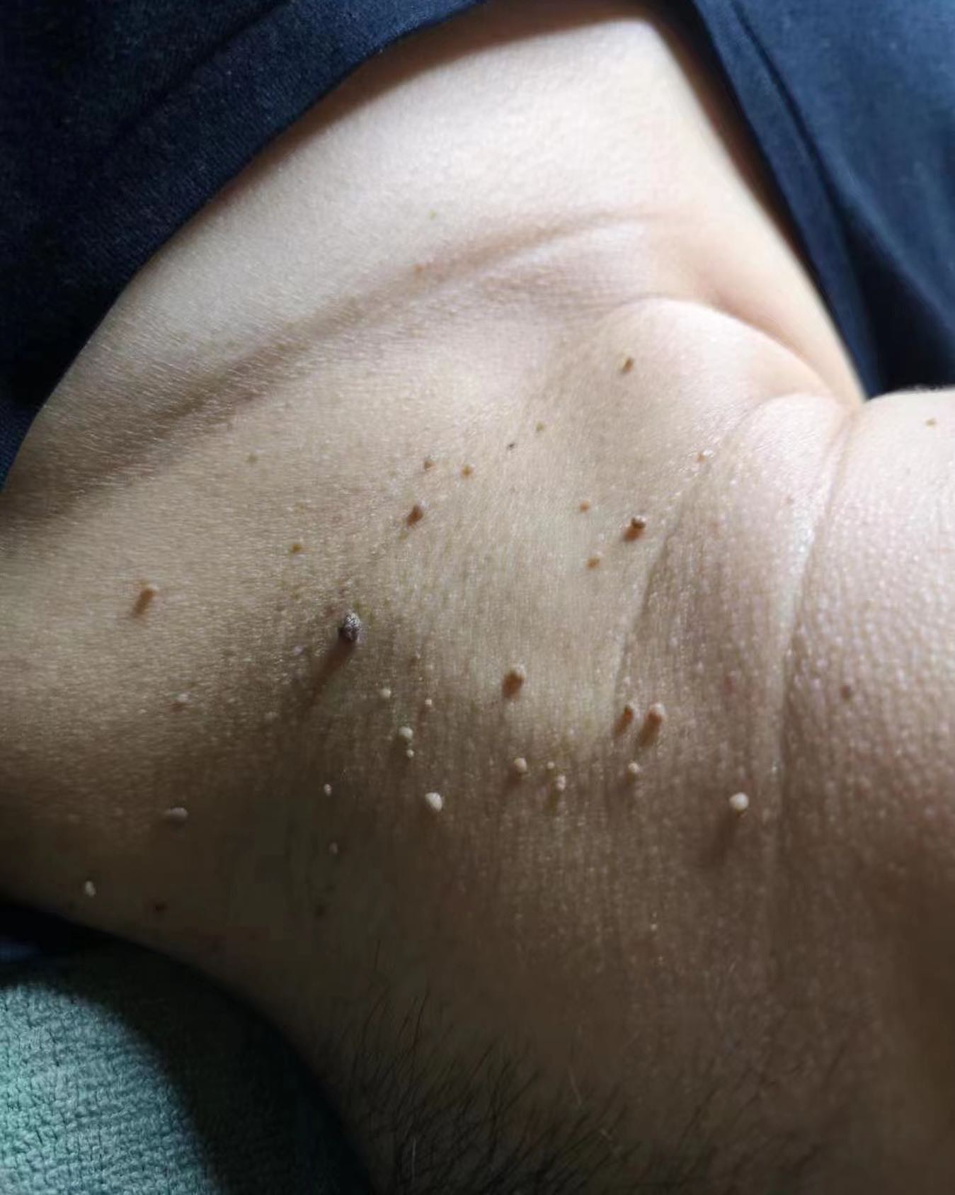 Don't ignore the "little skin tags "! 🚨 Warts can be annoying, but picking them can make them worse. And not just that, they can cause a series of infections. That's why it's important to pay attention to the harm that HPV, flat warts, and filiform warts can cause to the human body. Early detection and elimination are key to prevent them from spreading. These skin conditions not only affect your appearance but are also highly contagious, so take the necessary steps to prevent their spread! 🙌🏼 #skincare #warts #hpv #skinhealth #prevention