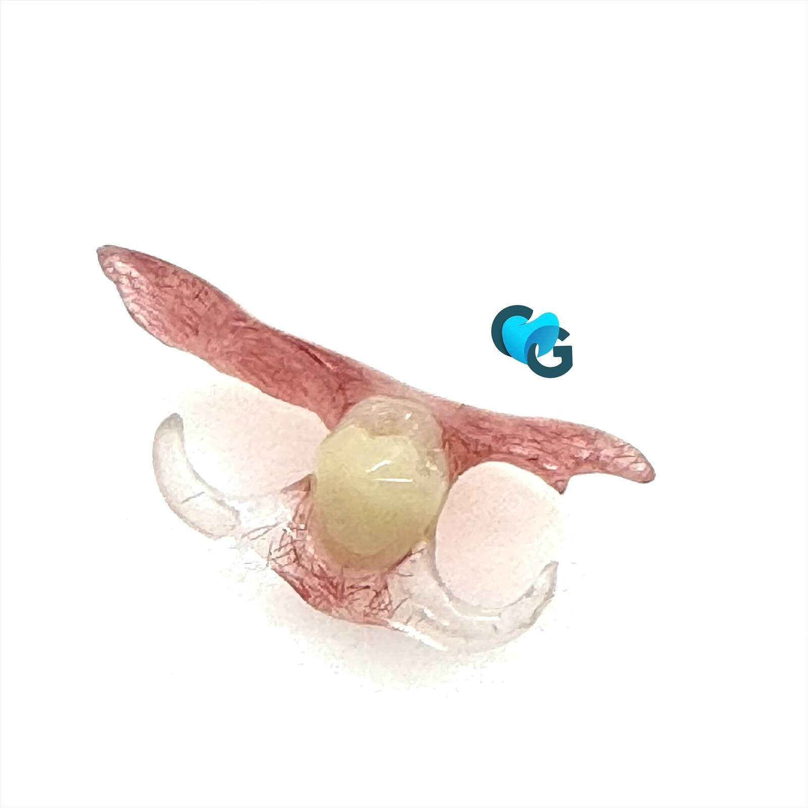 #valplastflexible #valplastdenture #partiel #amovibledentistry #prothesedentaire #unilateral #dent #dentalart #laboratoiredentaire #protheseamovible #clearsplint