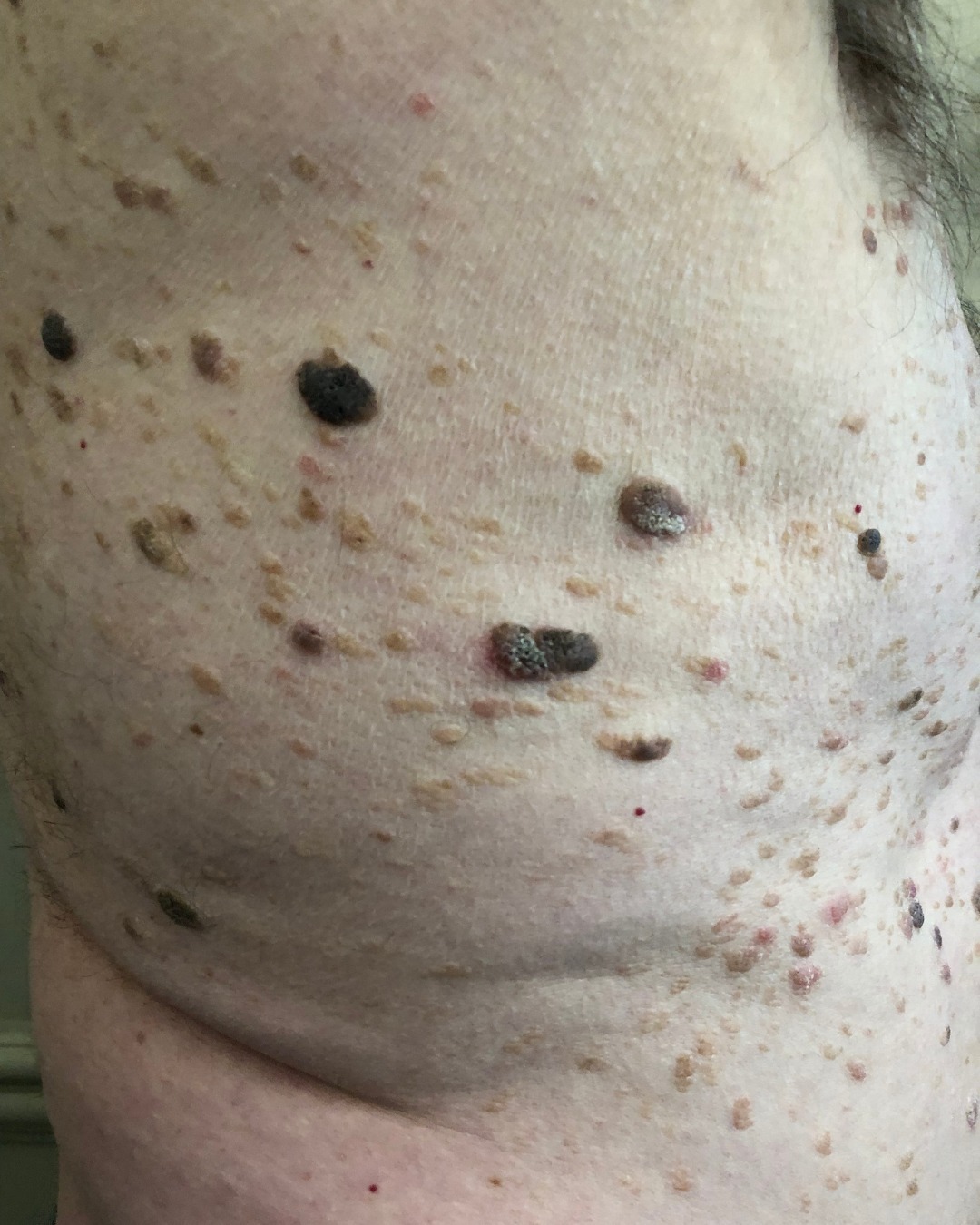 Seborrheic keratosis is a skin growth in the wart family that can appear on the face or over the body, as shown here.
Whilst mostly harmless, they can be itchy, uncomfortable and catch on clothes when there's multiple.
The removal of skin blemishes like this, especially when they are in large quantities can be truly life changing.
If you have just a small group of blemishes, we can often remove them in 1 session. However, multiple blemishes over a larger surface area will likely require a number of sessions. We'll also need to allow 6 weeks in between to allow time to heal before moving onto the next area.
Book a consultation with us if you'd like to remove your skin blemishes and restore your confidence!