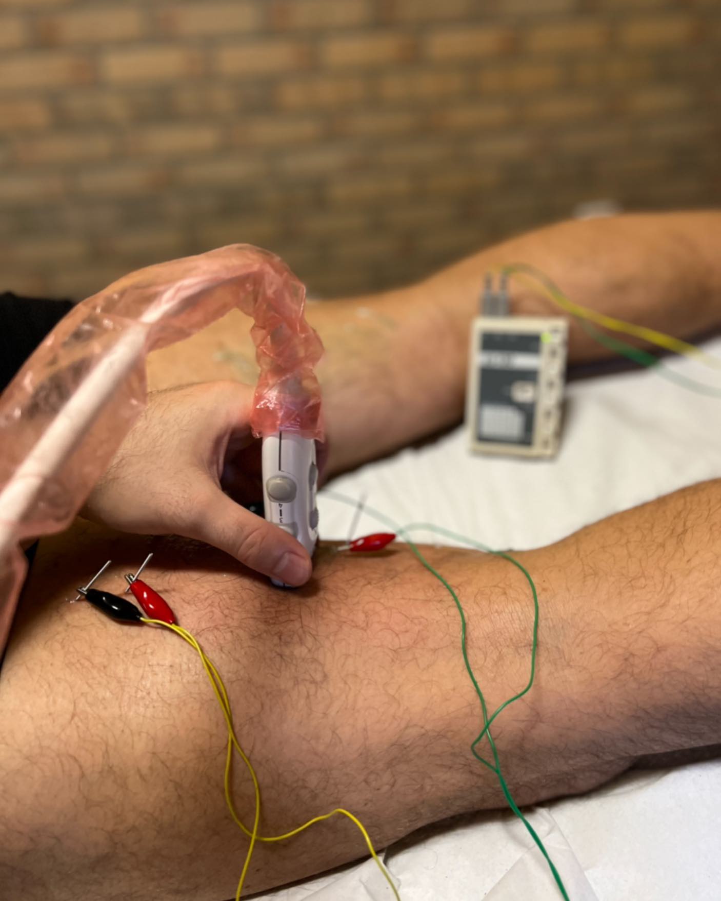 ¿CONOCES LA IMPORTANCIA DE USAR ECOGRAFÍA EN TRATAMIENTOS INVASIVOS DE FISIOTERAPIA?
El uso de la ecografía como herramienta complementaria en la aplicación de técnicas invasivas en fisioterapia, cómo pueden ser la punción seca, la electrólisis o la neuromodulación percútanea, es cada vez más extenso entre los profesionales de la fisioterapia.
Esto tiene varias razones y es que usar esta herramienta nos aporta:
✅ Mayor precisión en los abordajes
✅ Evitar contactar con la aguja paquetes vasculares, lo que podría suponer un riesgo para el paciente y aumento del dolor post tratamiento
✅ Estimular de forma más efectiva las zonas seleccionadas
✅ Explicar al paciente de forma más detallada la intervención en directo
✅ Mejores resultados en el tratamiento
⛔️Pero sobretodo, nos permite saber cuándo NO debemos tocar a un paciente, evitando situaciones de iatrogenia.
#fisioterapia #rehabilitacion #ecografia #lesiones #fisioterapiainvasiva #dolor #neuromodulacion