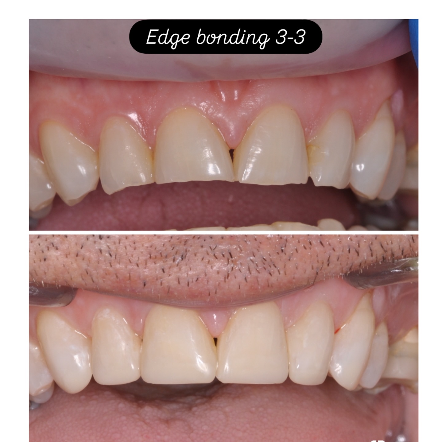 Edge bonding to improve esthetics #compositebonding #compositebondingmanchester #smilemakeover #compositebondingprestwich #compositeveneersmanchester