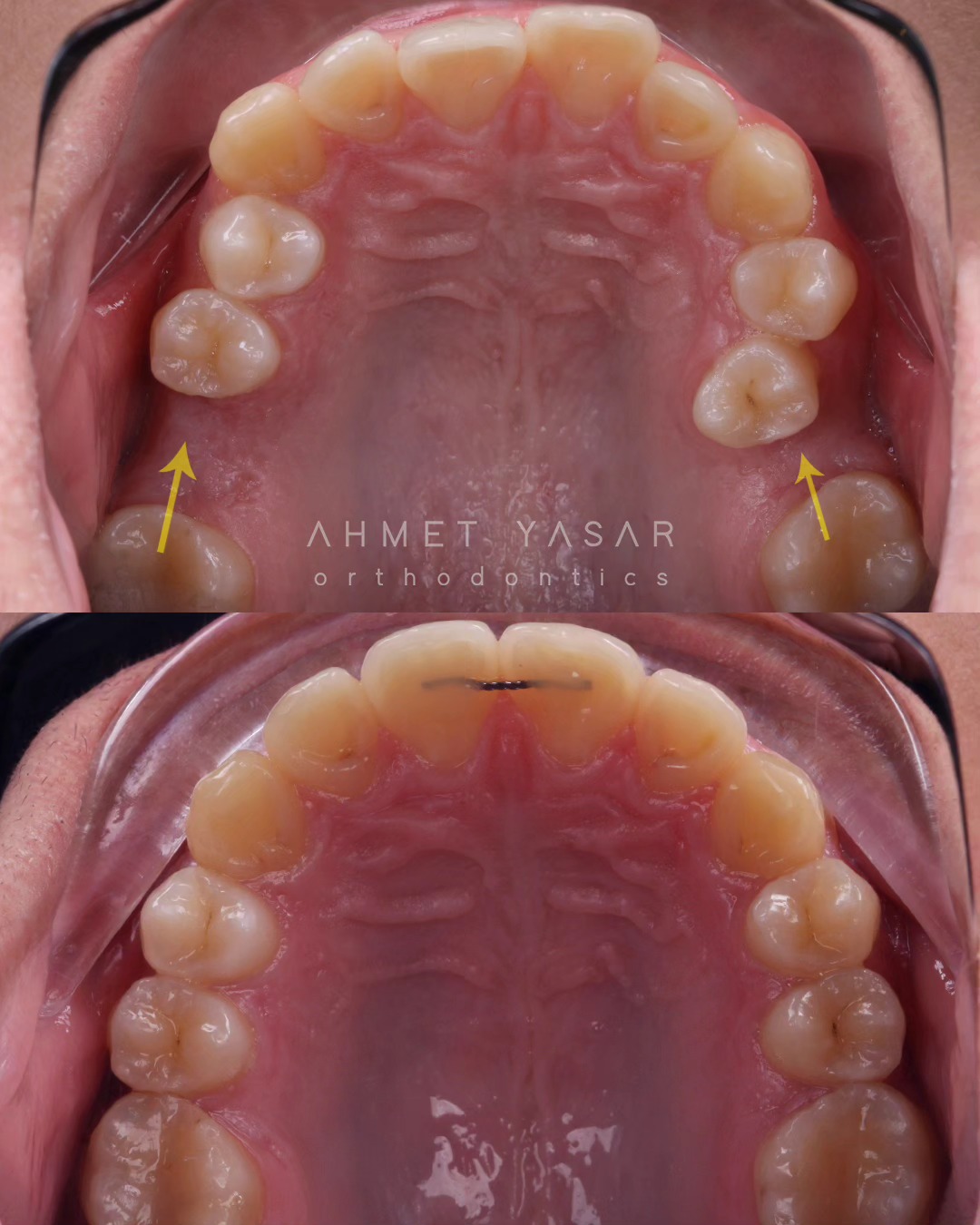 Closing the extraction spaces.
Çekim boşluklarının kapatılması.
.
Our clinic is authorized by the Ministry of Health of the Republic of Türkiye for International Health Tourism. All patients have been informed and have provided consent for the use of their photographs on our social media platforms. All content shared on social media is intended to inform patients about procedures and should not be perceived as advertising. Outcomes of any surgical or interventional treatment may vary from person to person. It is recommended to consult your physician for detailed information before undergoing any procedure.
.
.
.
#ortodonti #ortodontist #bursa #fsm #bursaortodonti #bursaortodontist #bursaortodontiuzmanı #orthodontics #braces #teltedavisi #invisalign #invisalignbursa #şeffafplak #lingualortodonti #lingualorthodontics #dişteli #ortholove #selfligating #kapaklıbraket #gülüştasarımı #dent #dentistry #art #picoftheday #photography #estetik #dentalart #ahmetyasar #drahmetyasar