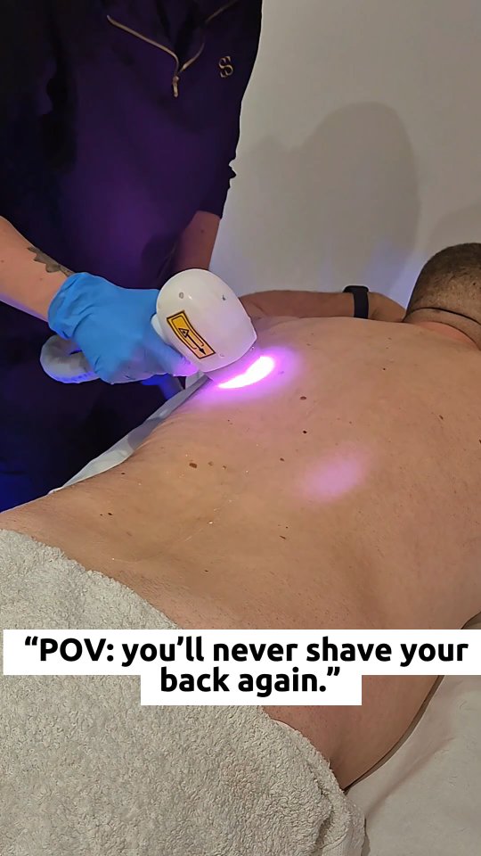 Say goodbye to back hair for good
Laser hair removal is the low-maintenance solution for men who are done with shaving, waxing and constant regrowth.
✔️ Long-term hair reduction
✔️ No ingrowns or irritation
✔️ Quick treatments
✔️ Perfect for backs, shoulders & chest
Whether it’s for confidence, comfort or convenience — laser does the hard work so you don’t have to.
📍 Professional clinic
📆 Courses of treatments available
💳 Payment plans available with Klarna & Clearpay
📩 DM LASER to book
🔗 Or book directly via our website
Smooth. Simple. Sorted.
#laserhairremoval#laserhairreduction#laserhair#essexlaserclinic#essexlaserhairremoval#basildonbeautytreatments#basildonlaserhairremoval