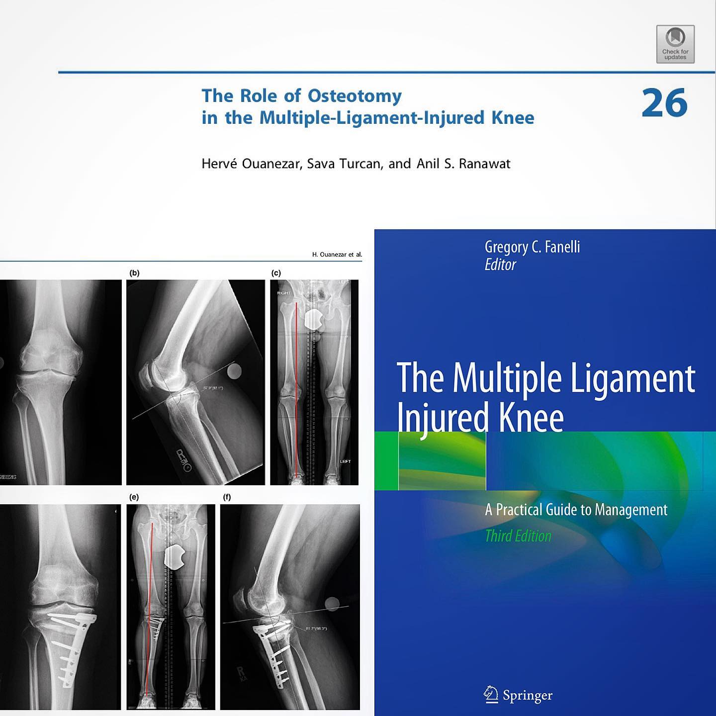 Proud to be co-author with my mentor Dr Anil Ranawat from @hspecialsurgery of this chapter about knee osteotomy in the brand new edition of Dr Fanelli’s book💪