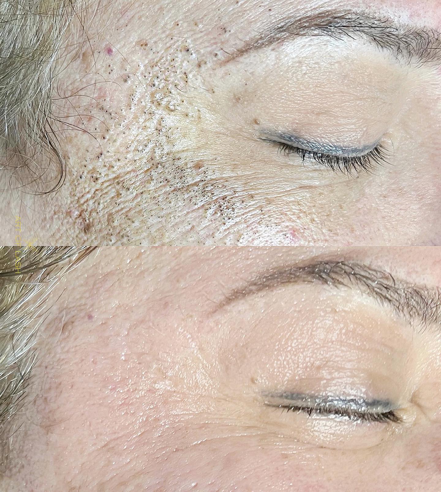 HEALTHY skin ✨
This client came to us wanting improvement with congested skin, fine lines and wrinkles - this is the result after ONE facial.
During our Customized Facial we asses your skin and treat it accordingly, we also help set up a home skincare routine to make sure your skin will continue to thrive between professional treatments. Not to mention our sculpting massage with leave you with a healthy lift and glow.
・
・
・
・
・
・
For Lash, Brow, Skin or Cosmetic Tattoo bookings please visit ➡️ www.artoflash.com (or click the link in our bio) to schedule.