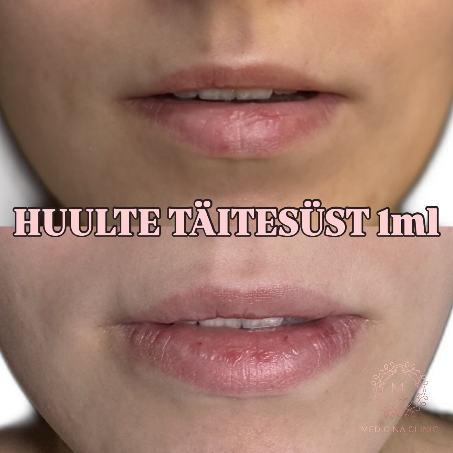Huulte täitesüst – enne & pärast 💉💋
Õrn volüüm, parem niisutatus.
Loomulik tulemus, kus huuled on nüüd veidi täidlasemad ja sümmeetrilisemad ✨
#huultetäitesüst #lipfiller #huulteniisutus #loomuliktulemus #medicinakliinik
