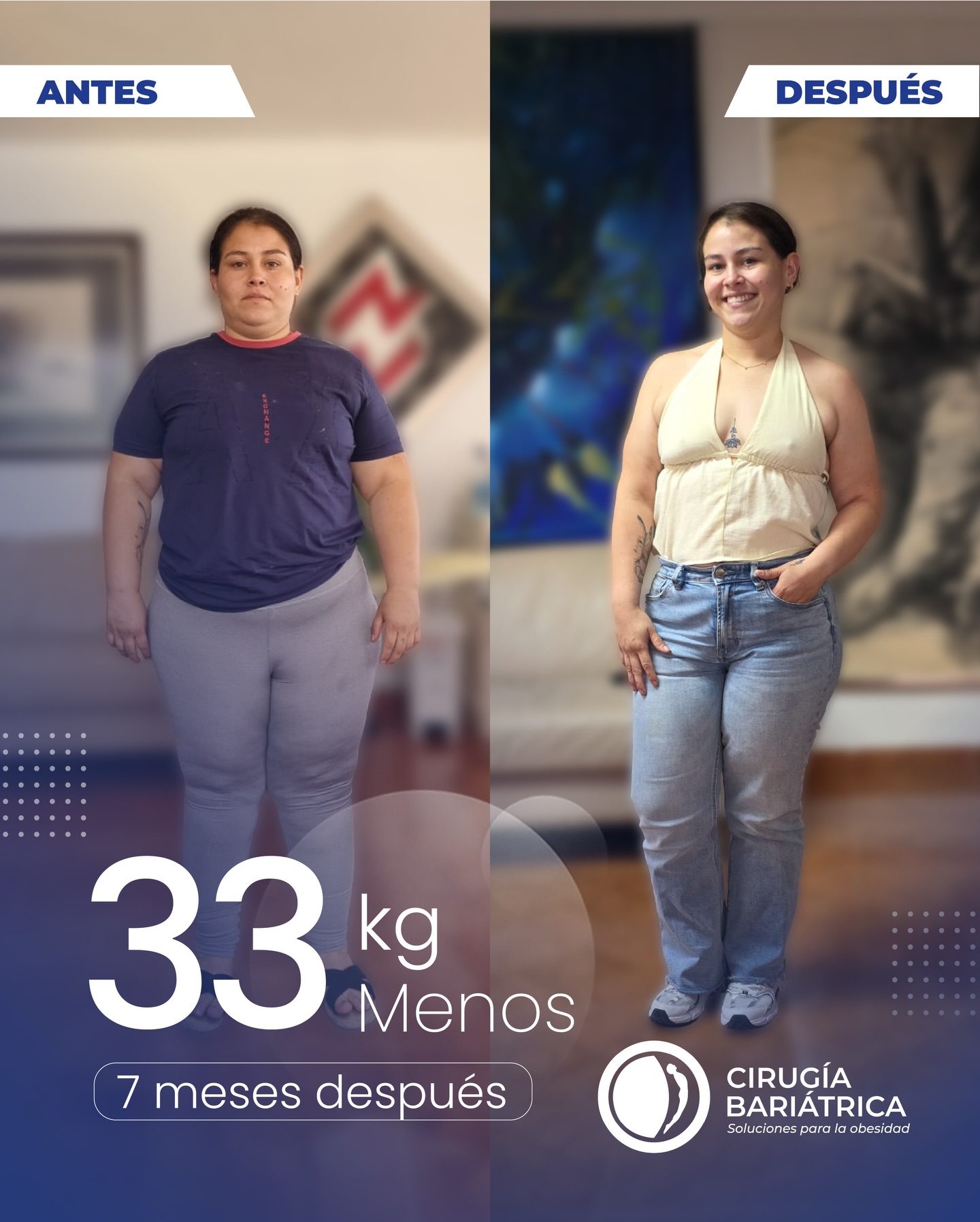33 kilos menos en 7 meses y una vida completamente transformada. 🙌✨
Gracias a la cirugía bariátrica, la tecnología de alta precisión y el profesionalismo de un equipo con amplia experiencia, hoy esta paciente disfruta más salud, más energía y una mejor calidad de vida.
Cada proceso es personalizado, cada resultado es un compromiso real con el bienestar del paciente.✨🌻🌞
#bariatrica #bariatricsurgery #bajardepeso #weightlosssurgery #bypass