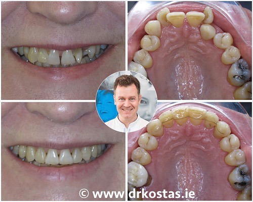 It's never too late to boost your smile confidence. More than 50% of our patients are adults and we pride ourselves on providing custom solutions for each of our clients. Get in touch today to schedule your FREE consultation with Dr. Kostas. Trust your smile to a specialist ๐๐
#drkostas #kostasortho #orthodontist #braces #dublinbraces #smile #smiletransformation #dublinorthodontist #smilemakeover #dublin #orthodontics #straightteeth #teethstraightening #damonbraces #cosmeticdentistry