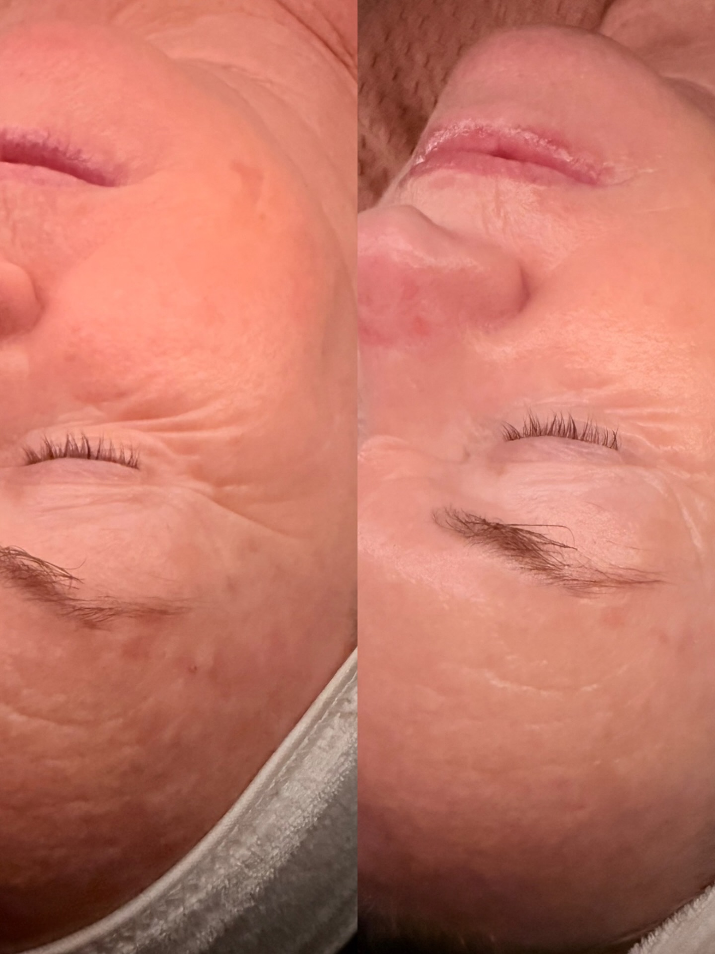✨ PROOF IN THE PEEL ✨
Can we just take a moment for this before & after? 😮💨 This transformation came from one of our go-to glow rituals:
➡️ Enzyme Peel
➡️ LED Light Therapy
➡️ Hydrating Sheet Mask
The result? Smoother texture, reduced fine lines, plumper skin, and that “I’ve had a full night’s sleep and drank 3L of water” kinda glow 💧💡
Enzyme peels are perfect for anyone who wants results without the downtime. Think of it like a gym session for your skin — we’re stimulating, exfoliating and rejuvenating at a cellular level (without any harshness). Pair it with LED and a clinical-grade sheet mask and you’ve got a facial that actually does something 👏
💬 Want this for your skin? Send us a DM with the word GLOW to book for only $99- this includes our Full Body RED LIGHT LED 😮
Because ageing gracefully doesn’t mean doing nothing — it means doing the right things 💖
#SkinResultsTweedHeads #LEDLightTherapyTweedHeads #MatureSkinClinic #AgeingWell #SkinClinicTweedHeads