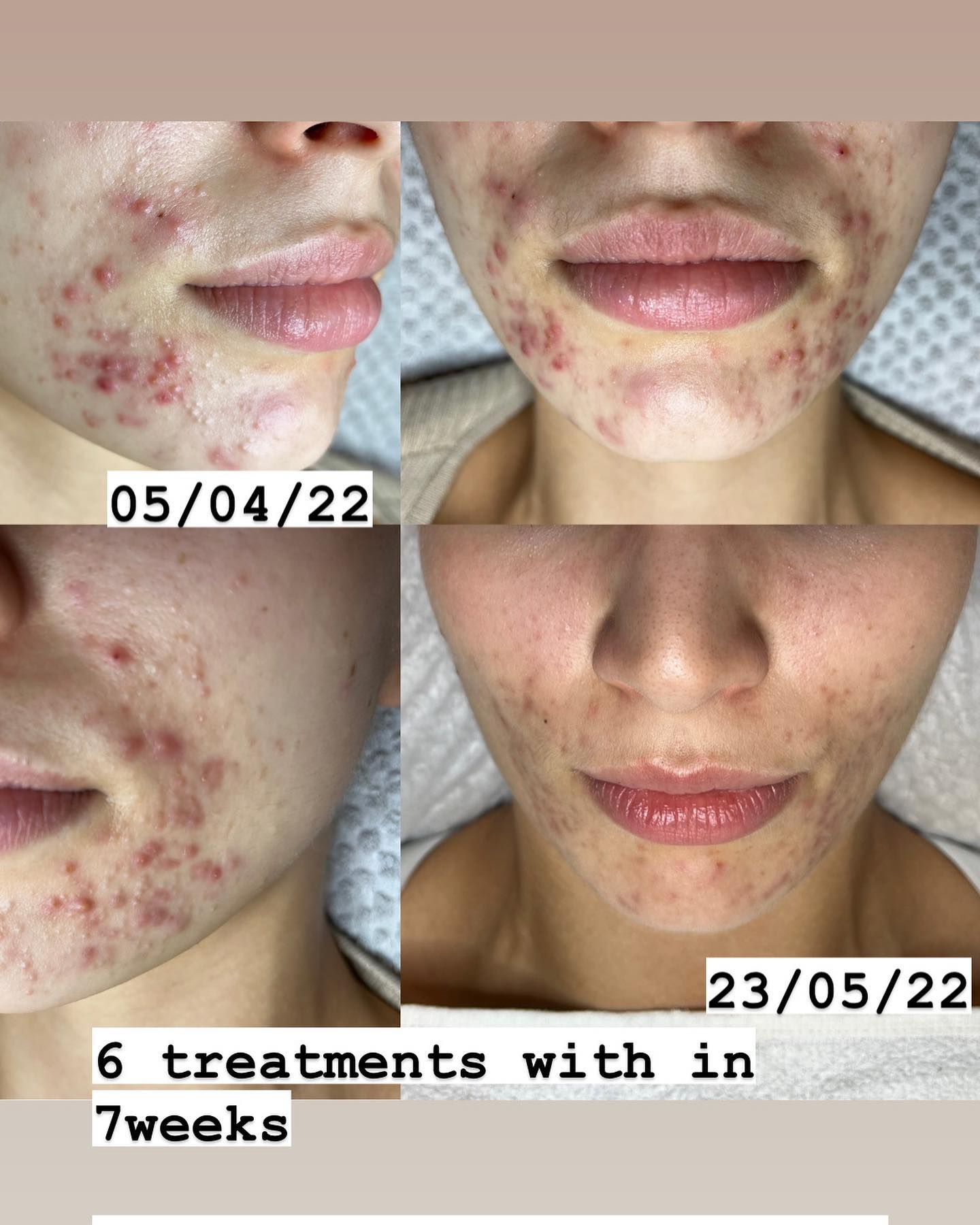 6 treatments with in 7weeks