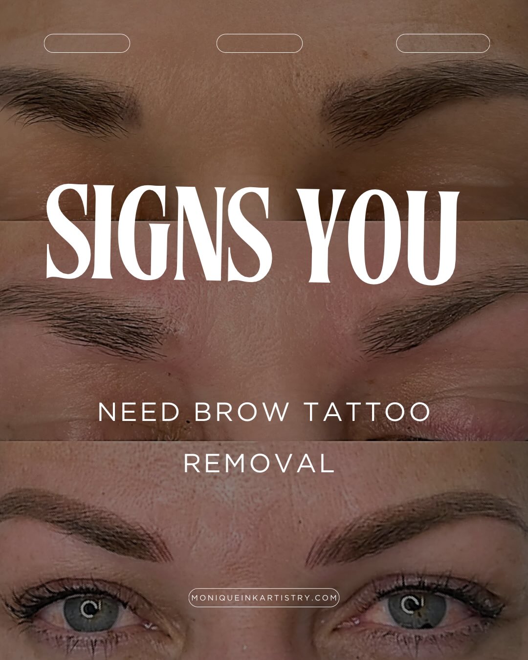 #laserremoval #browtattooremoval #invercargill