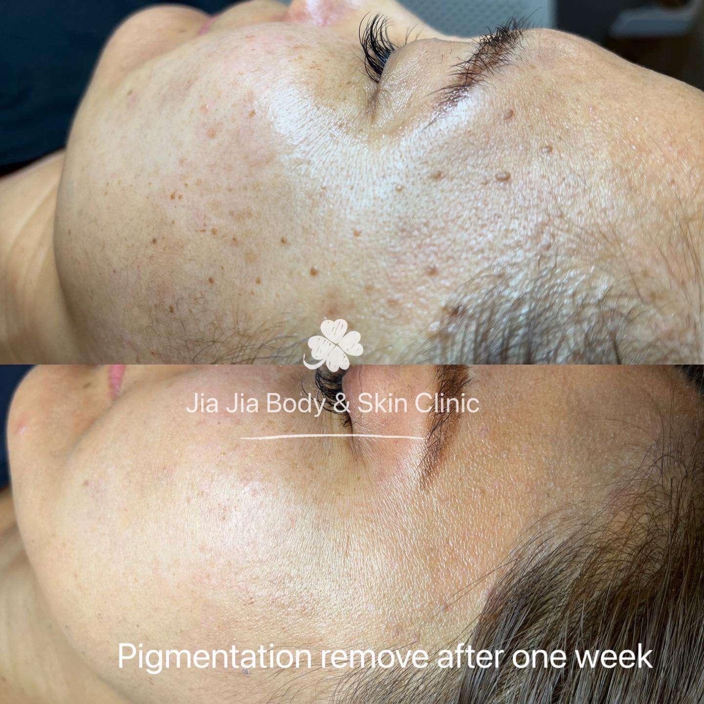 Pigmentation remove after one week
#cosmelan #pigmentationtreatment #clearskin #mesotherapy #skintagremoval #jiajiabodyandskinclinic #pigmentation