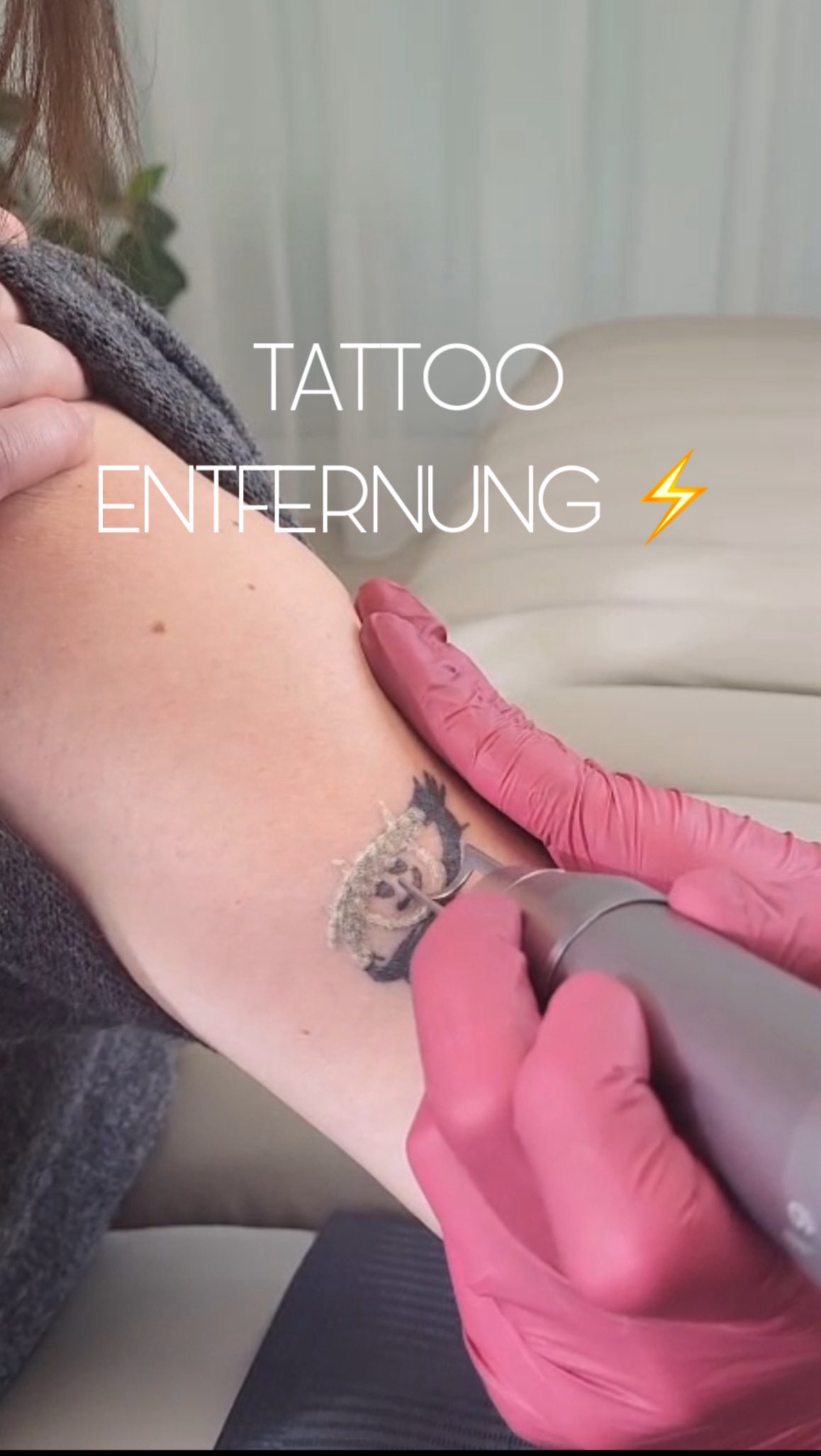 Ich lasere nicht aggressiv.
Und genau deshalb funktioniert es so gut.
Keine offenen Stellen.
Keine Blasen.
Keine Krusten.
Die Haut bleibt intakt, du hast keine Ausfallzeit –
weil ich nicht einfach „draufhalte“, sondern ganz genau weiß, was ich tue. Denn gestresste Haut kann nicht ansatzweise so viel Pigment abbauen, als schonend behandelte.
Das Gespür dafür, wie viel Energie welche Haut und welches Tattoo verträgt habe ich mir durch jahrelange Erfahrung und Arbeit mit der Haut angeeignet.
Genau diese Erfahrung macht den Unterschied, und macht die Behandlung bei mir zu 100% sicher.
Starte jetzt deinen Weg zu klarer Haut ohne Kompromisse ⚡️
PICOLASER
TATTOOREMOVAL
TATTOOENTFERNUNG VORARLBERG
TATTOOENTFERNUNG SCHWEIZ