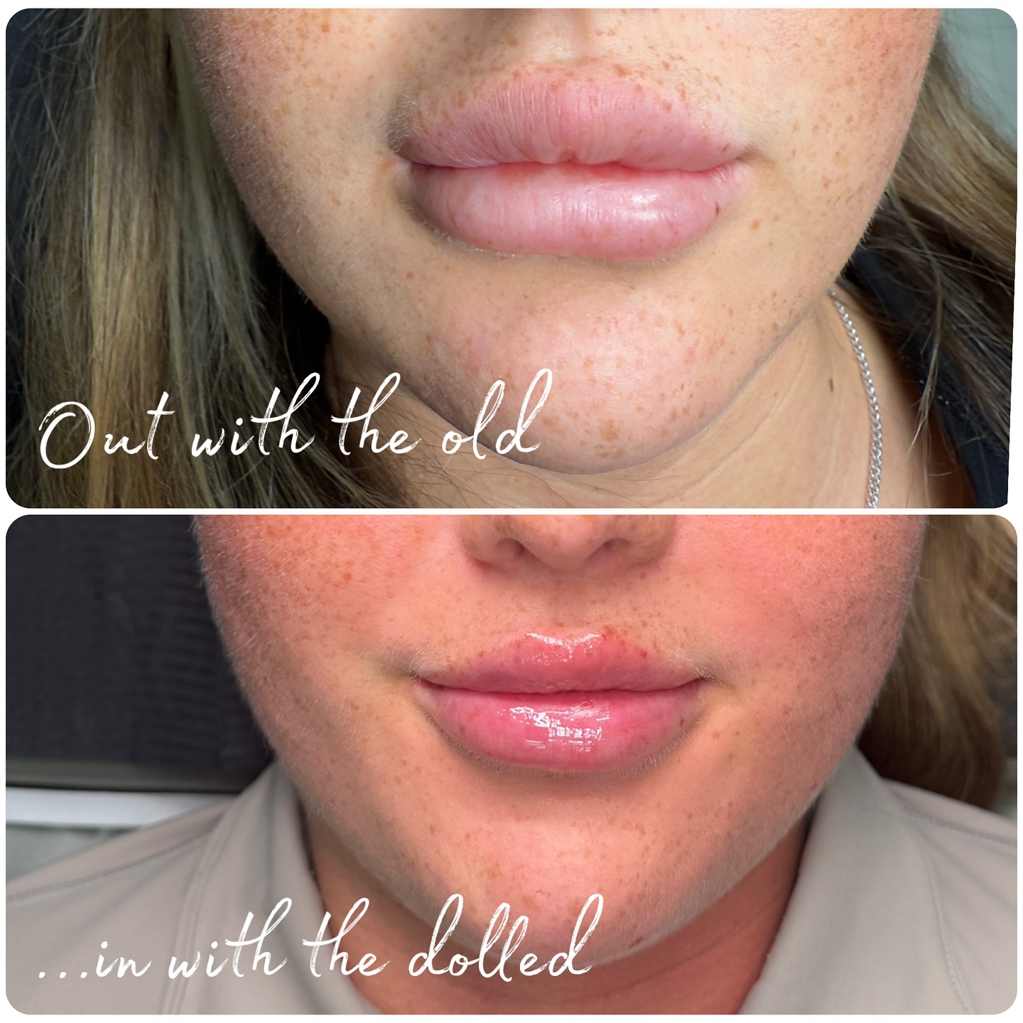 Did you know filler doesn’t always “fade away” on its own? In many cases, it can stay in the lips for years.
When lips are repeatedly filled without proper assessment, they eventually run out of space. That’s when shape and definition are lost, and filler starts to migrate above the lip.
This gorgeous client had her lips treated multiple times by different practitioners, which led to lumpiness, poor definition, and a duck-like side profile.
We dissolved the old filler and refilled after 3 weeks to rebuild the lips properly. It’s normal for volume to drop after the first refill, so she’s already booked in at 8 weeks for her second layer - slow, safe, and structured for the best result.