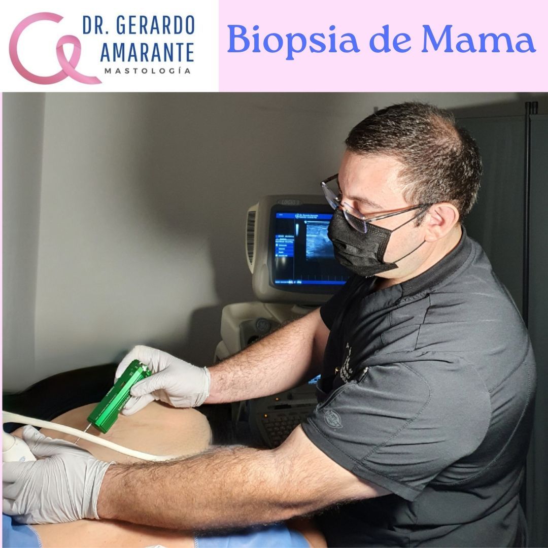 Si en tus estudios se encontró alguna anormalidad y se recomienda realizar estudio histopatológico, la mejor manera de hacerlo es mediante una biopsia cerrada, ésta puede ser por diferentes modalidades, una de ellas es guiada con ultrasonido y es un procedimiento seguro bajo anestesia local. Si tienes dudas de tus estudios o te recomendaron una biopsia en quirófano no dudes en pedir una segunda opinión.
🥼 Dr. Gerardo Amarante
📍Centro de Cáncer de Mama Hospital Zambrano Hellion
📍GAMA Medicina de Alta Especialidad Col. Obispado
📍Hospitaria Hospital
☎️ Citas y Whatsapp 8115552813
#mastologo #cirugiademama #cancerdemama #mastologia #cancer #mastectomia #reconstrucciondemama #cirujanoespecialistaenmama #biopsiademama #oncologia #consultademama #cirugiaoncoplastica #octubrerosa #segundaopinion