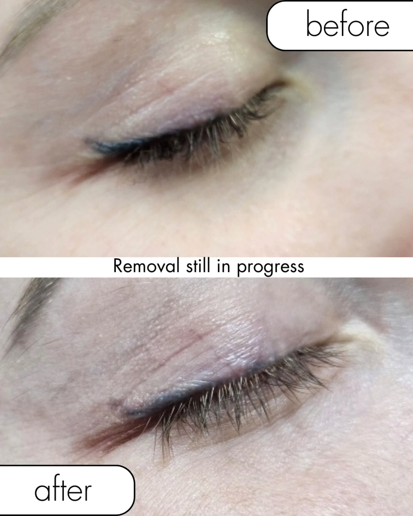 โจ Eyeliner Saline Tattoo Removal Progress Shot
Hereโs a before & after from a clientโs saline tattoo removal session that is still in progress, but.... you can already see the pigment softening and lifting!!!
If youโve ever had botched eyeliner unwanted permanent makeup, or old PMU you want to fade safely, saline removal @ might be exactly what youโre looking for.
๐ Every session gently lifts pigment โ results happen gradually with proper healing and care @liftinkremoval
Do you have unwanted eyeliner or Microblading? Send me a DM or tap the link in my bio! ๐
#salinetattooremoval
#erasebotchedeyeliner
#permanentmakeupremoval
#pmuremove
#pmuartist