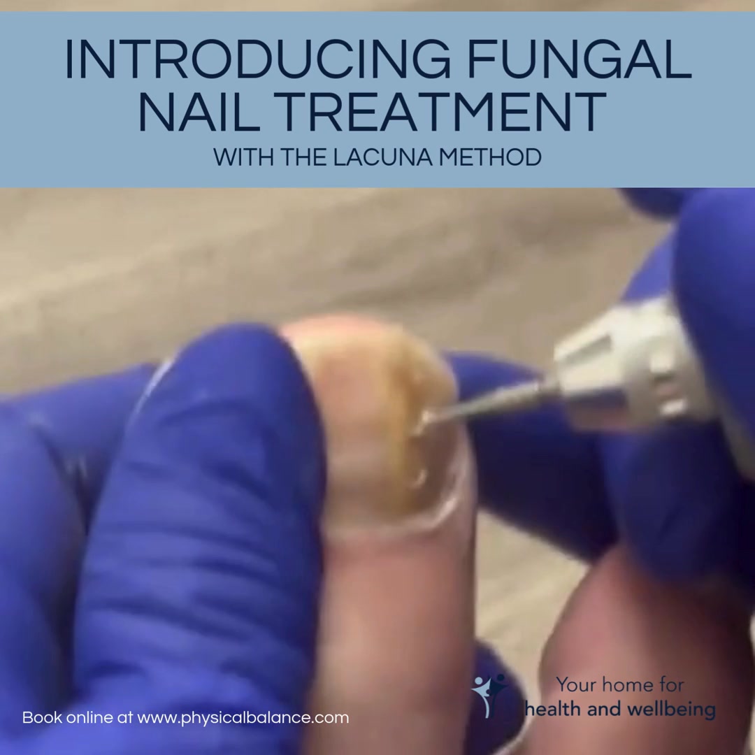 ✨ NEW TREATMENT NOW AVAILABLE ✨
Struggling with fungal nails?
We’re pleased to introduce The Lacuna Method here in clinic - a simple, effective, and pain-free treatment designed to target nail fungus safely and comfortably.
🔍 Common signs of nail fungus include:
• Thickened nails
• Crumbly or brittle nails
• Nails lifting or becoming distorted
• White, yellow, or brown discolouration
• Dull nails with no healthy shine
Appointments are available every Wednesday & Friday with Sarah, and every Monday & Thursday with Gillian.
If you'd like to learn more, or to make an appointment, visit our website (link in our bio) or call us on 01256 770022 and we'll be happy to help 😊 #physicalbalance #thestudioatphysicalbalance #basingstokeclinic #foothealthcarebasingstoke #verrucatreatmentbasingstoke #nailreconstructionbasingstoke #fungalnailtreatmentbasingstoke #lacunamethodforfungalnailtreatmentbasingstoke