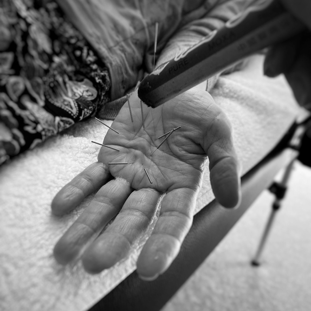 A little combo treatment involving acupuncture and moxibustion for the treatment of Dupuytren's Contracture.
We love treating all sorts of conditions in the clinic! 🔥