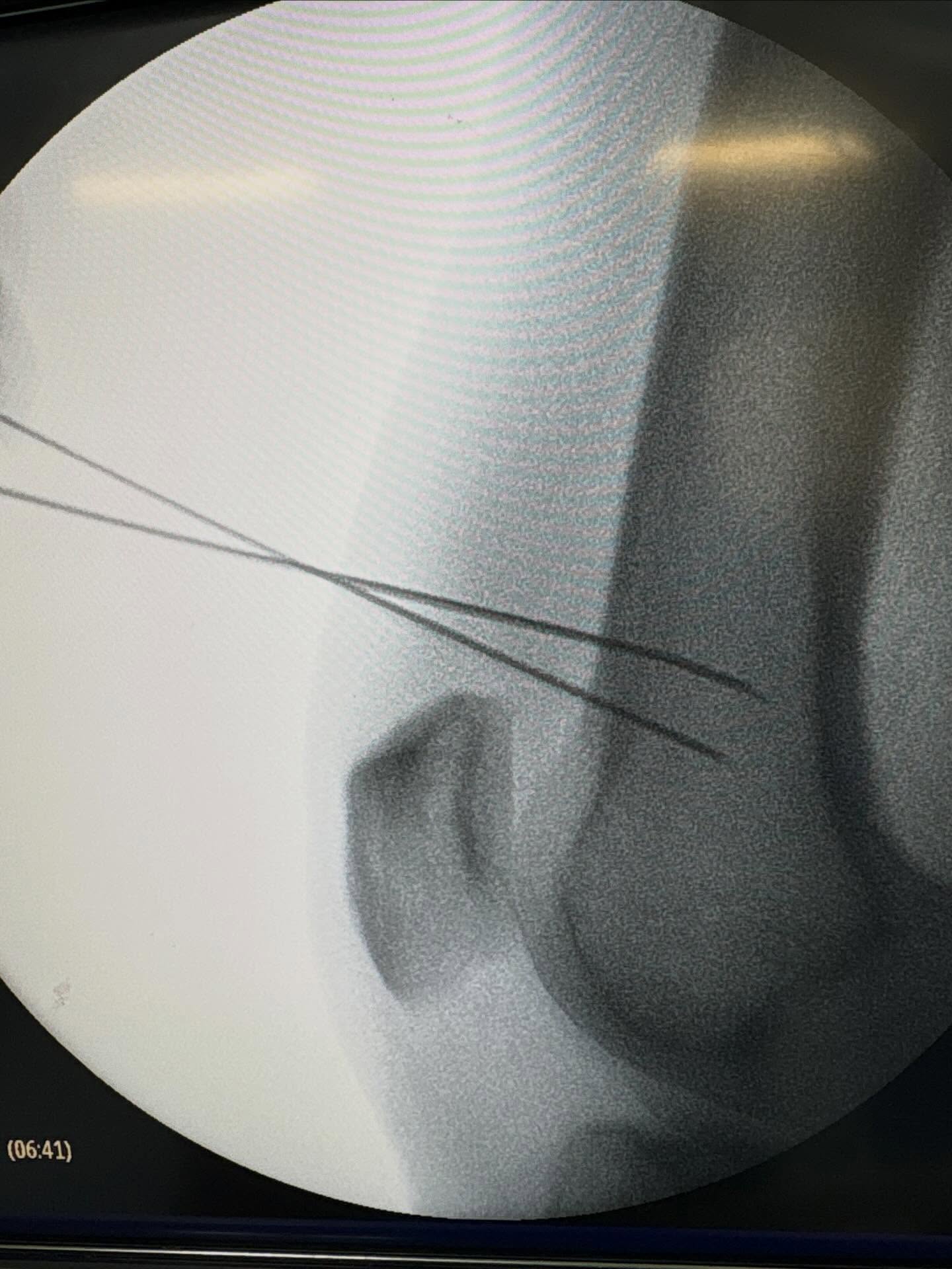 La radioablasion de nervios geniculados en rodilla es una alternativa de mínima invasión para el tratamiento de dolor crónico y refractario a tratamiento conservador en pacientes no candidatos a prótesis de rodilla.
