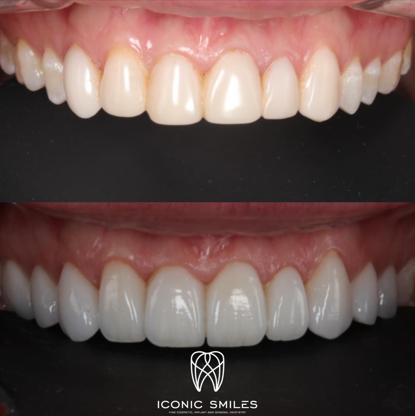 🌟Porcelain Veneers 🌟
Porcelain veneers are not all the same! We have added natural details to the veneers and a glass like finish to the veneers to finish with this rejuvenating smile.
DISCLAIMER
All information provided by Dr Matthew El Azzi - DEN0001996783, Registered Dentist, is for general and educational purposes only. It does not constitute medical advice and should not be relied upon as a substitute for professional consultation.
Images and videos are of real patients who have given consent. No filters, AI enhancements, or unrealistic lighting are used. These materials are intended to demonstrate examples of treatment but do not guarantee results. Individual results, risks, potential complications, and recovery times vary between patients.
Patient stories are individual experiences and should not be interpreted as indicative of expected outcomes for all patients. Your experience may differ.
Before commencing any treatment, you should seek independent advice from a qualified, AHPRA-registered health practitioner and consider obtaining a second opinion.
For details about each specific treatment, head to:
https://www.iconicsmiles.com.au
Dr Matthew El Azzi - DEN0001996783
Registered Dentist, General Registration