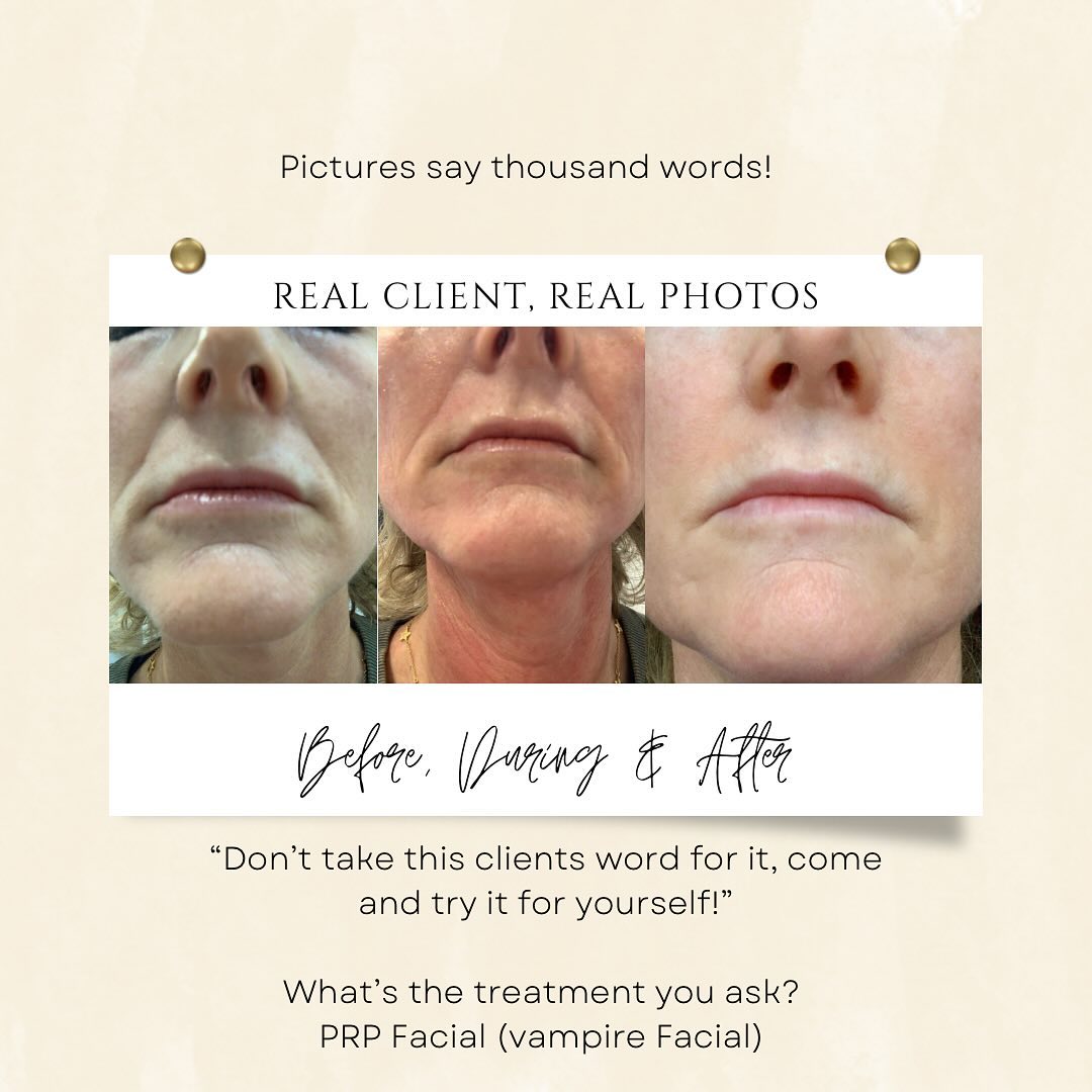 PRP Facial (vampire facial) performed by Hayley. Pop or call the salon for more information. 01787 378024