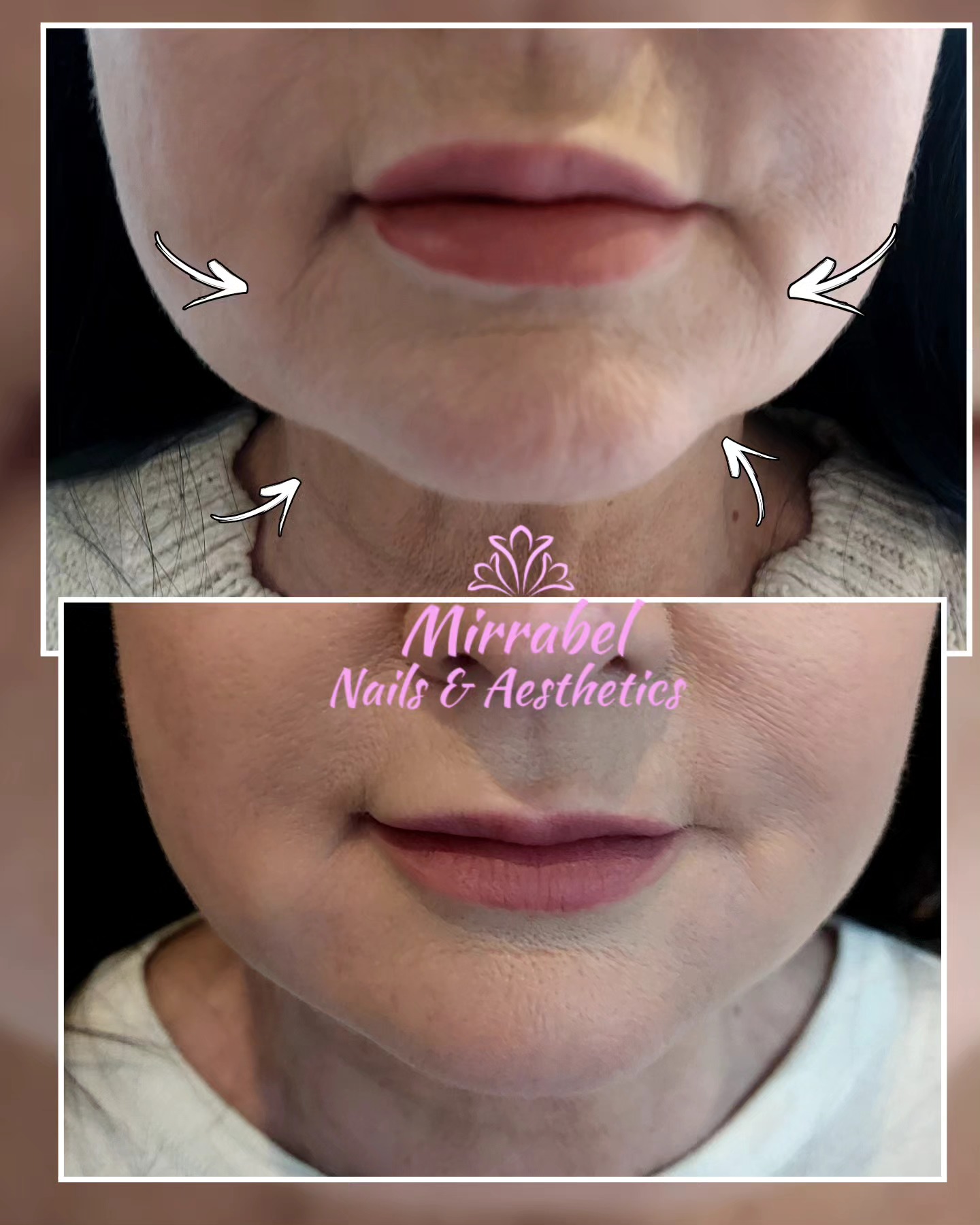 💉💉Before and 3 weeks after.
Fabulous improvement usjng hyaluronic acidfiller..we treated #marrionettelines and #jowls for more youthful look
💉💉
** free consultation
** 30min treatment
** minimal pain (topical anaesthetic used)
** Instant result
Hyaluronic acid Fillers replenish volume and stimulate collagen production, minimising the appearance of facial lines, wrinkles and folds for more youthful look.
Book yours 07894536122
#Altrinchamtoday #aesthetics #botox #antiwrinkleinjection #Altrincham #halebarns #halemums #hale #wythenshawe #timperleybeauty #timperleybeauty #fillers #nasiolabialfolds #sale #dermalfillers #wrinkles #nasiolabialfiller #nasolabialfold #smokerslinestreatment #marrionettelines #jowls #marrionettelines #jawfiller