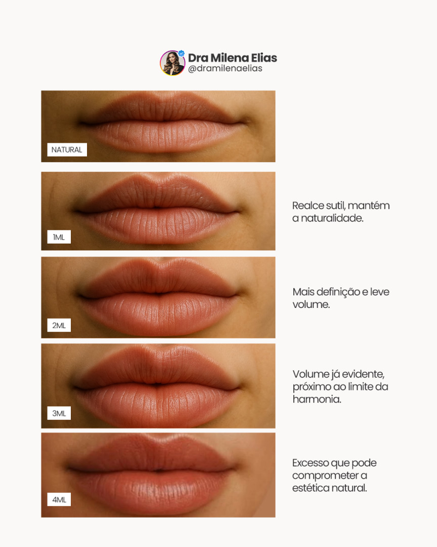 Lábios preenchidos não são “tudo ou nada”. Entre o natural, o levemente realçado e o exagerado, existem pequenas diferenças de volume e proporção que mudam completamente o resultado.
O objetivo de um bom preenchimento é conversar com o seu rosto: respeitar o formato da boca, o tamanho do queixo, a expressão, o sorriso. Quando isso é levado em conta, o efeito é de lábios saudáveis e harmônicos, não de algo que chega primeiro que a sua face.
Olhe com calma para cada etapa deste post e perceba em qual delas você se sente mais representada. Depois me conta nos comentários: qual desses resultados combina mais com o que você busca para a sua boca hoje?