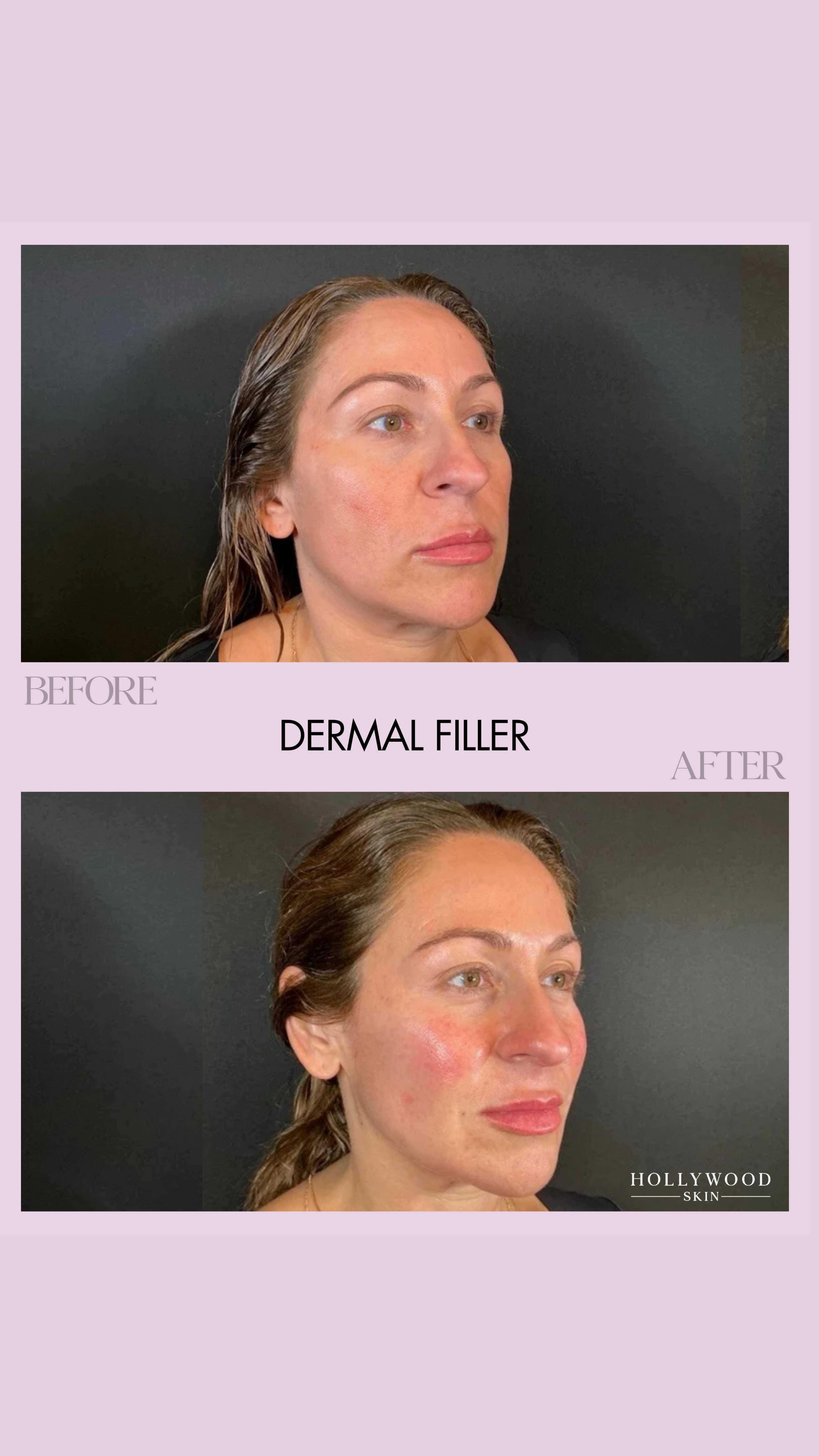 Another subtle but important sign of facial aging isn’t just sagging or hollowness. It’s how light reflects off the face.
As we age, we lose bone and facial fat, especially in the midface. When that support diminishes, light no longer reflects evenly across the cheeks. Instead of a smooth, soft reflection, light concentrates on the bony apex of the cheek and deeper shadows form below it. This is one of the reasons an aging face can look more tired or harsh, even when skin quality is good.
In a youthful face, volume is fuller and more evenly distributed. Light reflects smoothly across the cheeks with minimal shadowing. You can see this clearly when comparing my daughter’s face to mine. Her cheeks reflect light evenly, while mine shows light concentrated higher on the cheek with shadowing beneath due to volume loss.
This is why filler isn’t just about “adding volume.” When placed strategically, it can restore support, soften shadows, and shift where light reflects on the face, creating a more refreshed and natural appearance.
In this patient’s before and after, notice how light reflects differently off the cheeks and temples. There is also improved submental support in the after, contributing to a more balanced lower face.
Treatment details:�✔️ 3 syringes total�✔️ Cheeks�✔️ Pyriform area to support nasolabial folds�✔️ Jawline to reduce the appearance of jowling and submental fullness
The goal is not to change the face. It’s to restore structure so light reflects the way it once did.
