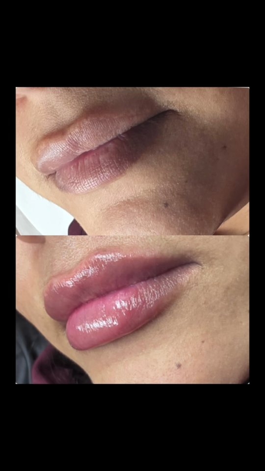 ✨ PREMIUM FILLER | LONGER-LASTING RESULTS ✨
0.6 used for this client
Luxury filler, smarter amounts, better longevity 💉💎
Our premium filler is designed to last longer while using less product, giving you beautifully refined, natural results.
💖 Why choose premium filler?
✔ Uses less filler for optimal results
✔ Longer lasting ! up to 18months
✔ Smooth, soft finish
✔ Perfect for lips, cheeks, jawline & contouring
💷 Pricing:
• 0.2ml – £50
• 0.4ml – £79
• 0.6ml – £99 ⭐ most popular
This is about quality over quantity enhancing your features, not overfilling them ✨
📩 DM to book your consultation
📍 Female-only | Luxury aesthetic space
#premiumfiller #dermalfiller #lipsbyshy #naturalaesthetics #lipfiller luxuryinjectables