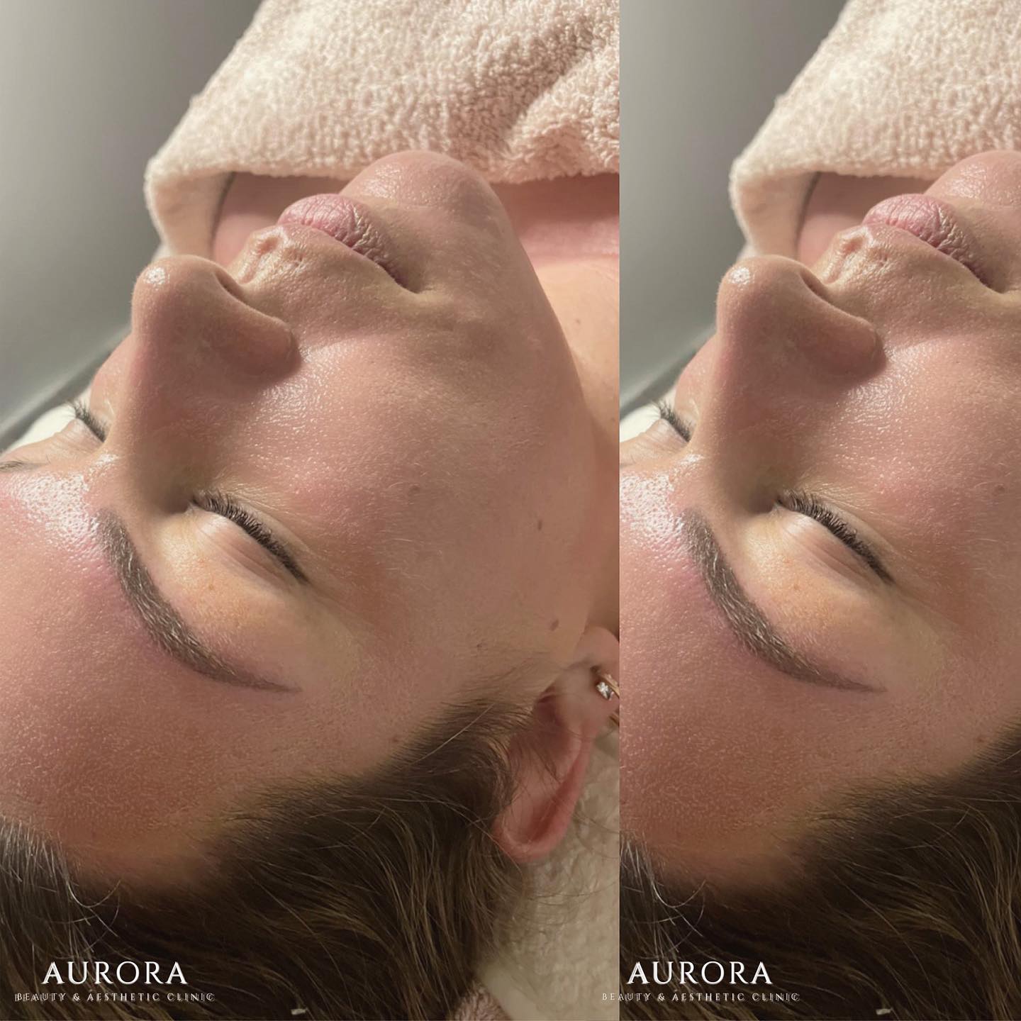 BENEFITS of BBGLOW
(ft. healed brows 🎉)
✨ even & clear complexion.
✨ brighten & smooth the skin tone.
✨ reduced appearance of brown spots & imperfections.
✨ reduced appearance of wrinkles.
✨ naturally boost collagen & tighten skin.
✨ clear & unclog blocked pores.
✨ minimise large pores.
🤍downtime 24hrs
🤍best results after 1 week
🤍longer lasting results with course of treatments
#bbglow #stayvebbglow #stayve #microneedling #facial #skincare #glow #mesotherapy #clearskin #facialtreatment #bbglowhampshire #bbglowsurrey #bbglowberkshire