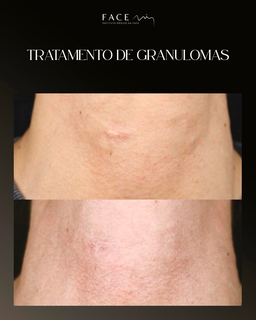 ANTES & DEPOIS - Endolift 🌟
Neste caso, o desafio era duplo: tratar a flacidez do pescoço e eliminar granulomas (pequenos nódulos que podem surgir após outros procedimentos).
Esta tecnologia de laser de última geração atua sob a pele, permitindo-nos:
✔️ Dissolver granulomas de forma precisa e segura.
✔️ Retrair a pele, combatendo a flacidez de dentro para fora.
✔️ Redefinir o contorno mandibular e do pescoço.
Tudo isto com um procedimento minimamente invasivo, sem cortes! 🤩
#endolift #endoliftlaser #facemi #facemibraga #facemiporto
Os casos clínicos apresentados refletem o antes e depois de pacientes específicos que deram o seu consentimento para serem apresentados nos canais e redes sociais do Instituto Face Mi. Cada pessoa é única e o resultado pode variar de paciente para paciente.
Todos os pacientes, antes de cada procedimento, passam por um processo de consulta médica de diagnóstico onde são avaliadas indicações, expectativas e motivações.
Registo ERS: 21236
Registo estabelecimento: E159774
Licença funcionamento: 21236/2022