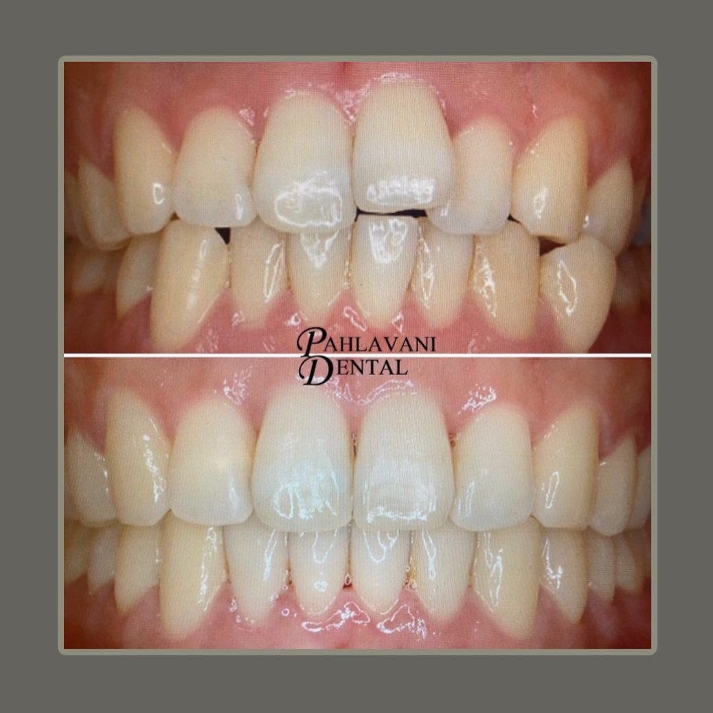 🌟✨Look at these results!! ✨🌟
😱😱😱
Pahlavani Dental has earned Invisalign Gold PLUS Provider Status 🌟 which means that we have the necessary experience help you reach a better smile with Invisalign!
If you would like to join our practice and experience Gold Plus🌟 treatment, contact us at:
📞: (202)797-0090
📧: info@pahlavanidental.com
🧑💻: www.pahlavanidental.com
#pahlavanidental #dcdentaloffice #womenindentistry #dentist #flosslikeaboss #invisalign #invisaligngoldplusprovider⭐️