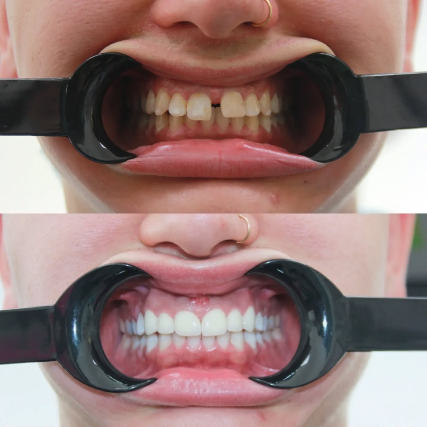 Hastamıza beyazlatma işlemi sonrasında üst ön 6 dişine zirkonyum veneer uygulandı ✨