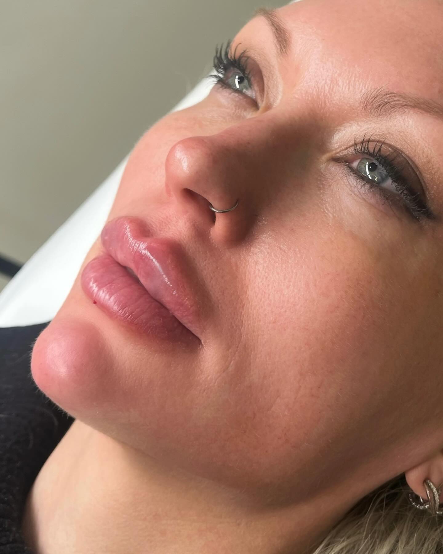 Kinn und Lippenaufbau ✨
Wie extrem schön ihre Jawline nur alleine durch den Kinnaufbau wirkt!
Sehr häufig reicht ein leichter Kinnaufbau völlig aus, um die Jawline zu definieren!
#kinnaufbau #hyaluron #hyaluronsäurelippen #bamberg #hyaluronsäure