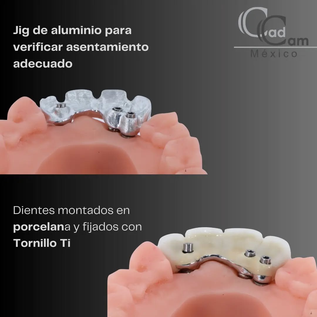 ¡La clave para un tratamiento sin complicaciones está en los detalles! Nuestro Maestro Técnico Dental, @thomasw.graber ha elevado la odontología a un nuevo nivel con su ingenioso diseño: un Jig de verificación fresado en aluminio. Este paso asegura un asentamiento perfecto antes de colocar la prótesis final, evitando posibles fallas de vasculación y simplificando el tratamiento. En CAD CAM México, nos enorgullece ser expertos en fresar Jigs de verificación para perfeccionar cada sonrisa. Confía en la precisión, confía en la excelencia. - - - Aviso de responsabilidad: Todas las fotos publicadas en esta cuenta de Instagram son propiedad intelectual de Estudio de Porcelana Suizo S.A de C.V. y están protegidas por derechos de autor.pin alvaro obregon 134 cuernavaca #CadCam #Mexico #Cromocobalto #implantologia #implantesdentales #dentistry #dentista