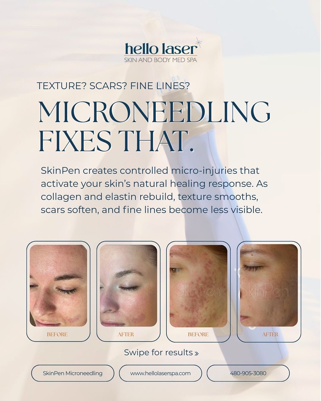 SkinPen Microneedling is one of our most requested aesthetic treatments and these before & afters show exactly why.
By boosting collagen and encouraging natural skin renewal, SkinPen helps improve texture, acne scars, fine lines, and overall skin tone over time. No filters, just real results from consistency.
Ready to start your glow-up?
Book your SkinPen Microneedling today at www.hellolaserspa.com
📲480-905-3080