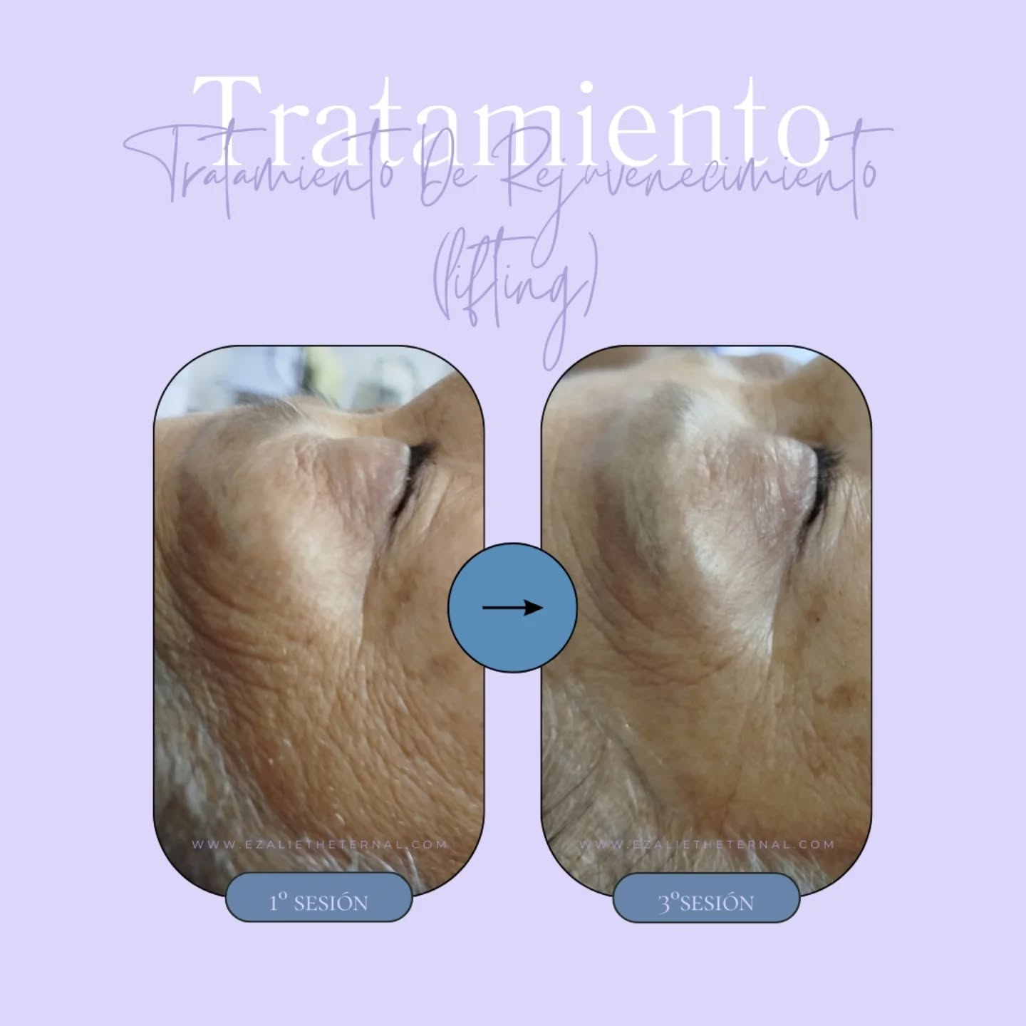 ¿Buscas una piel más firme y rejuvenecida? Este procedimiento estimula el colágeno y elastina, dejando tu rostro más rejuvenecido y luminoso 🌿
────────────
↳Beneficios:
• Reducción de arrugas y líneas de expresión
• Mejora de la elasticidad y firmeza de la piel
• Hidratación profunda y revitalización
────────────
📲 Contáctanos y reserva tu cita.
.
.
.
.
#cuidadofacial #spaadomicilio #ezalietheternal #cuidadofacialycorporal #pielluminosa