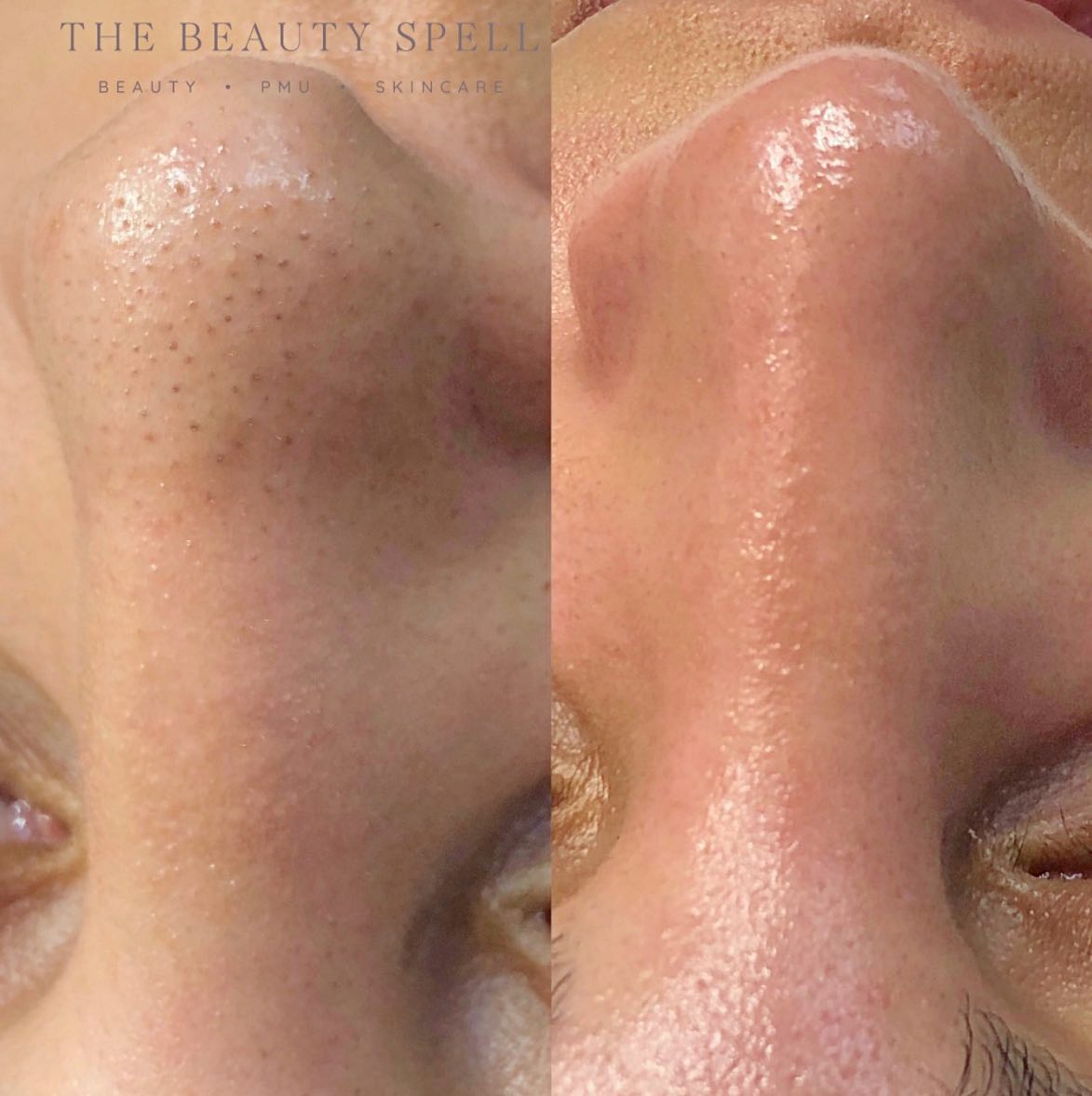 Hydrofacial✨
Die zwarte puntjes zijn simpelweg poriën die verstopt zijn. Ze raken verstopt met een mix van dode huidcellen, vuil en vet en ze komen over het algemeen vaker voor bij mannen. Je ziet ze meestal opduiken op de neus en kin of de "T-zone" net boven en tussen je wenkbrauwen.
Bij deze facial wordt je gezicht compleet gereinigd, alle onzuiverheden en dode huidcellen verwijderd. Hierdoor begin je de dag met een zachte en gladde huid.
#hydrofacial #facialtreatment #facial #skincare #skinhealth #skin #gezichtsbehandeling #gezichtsverzorging