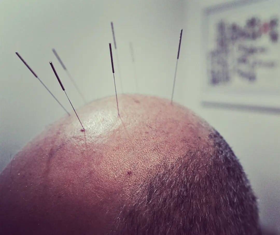 Long standing headaches due to trauma are a common ailment seen in the clinic.
#acupuncturenz #acupuncturehawkesbay #acupuncture #needlesinthehead
