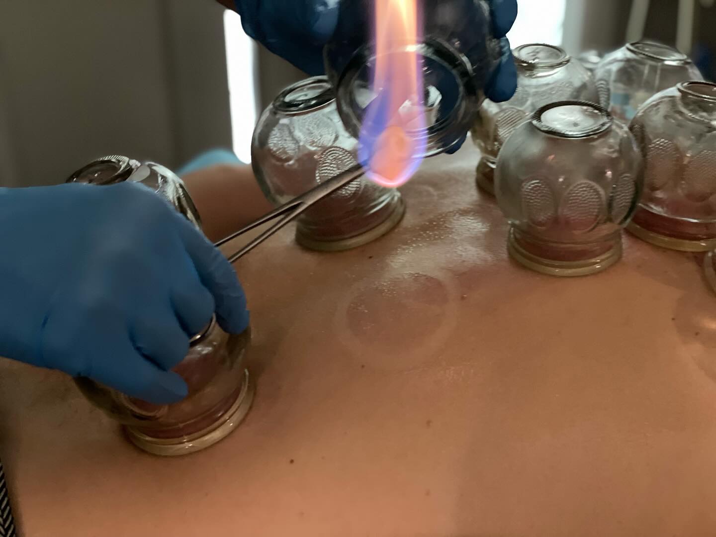 🔥 Fire Cupping for Athletic Recovery 🔥
Fire cupping gently lifts the skin away from the muscle, creating space that increases blood flow, oxygenation, and lymphatic drainage—helping your body clear inflammation and recover faster 💪
Perfect for sore muscles, tight fascia, injury recovery, and performance support for active bodies and athletes 🏃♂️🏋️♀️
📍 Conifer, Colorado
@momentwellnessacupuncture
#FireCupping #CuppingTherapy #AthleteRecovery #SportsRecovery #MuscleRecovery #LymphaticDrainage #BloodFlowHealing #TraditionalChineseMedicine #AcupunctureConifer #MomentWellnessAcupuncture #ConiferCO